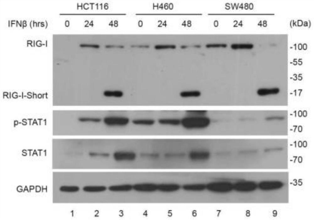 Application of reagent for detecting expression level of RIG-I-Shart in preparation of products for tumor diagnosis and/or prognosis