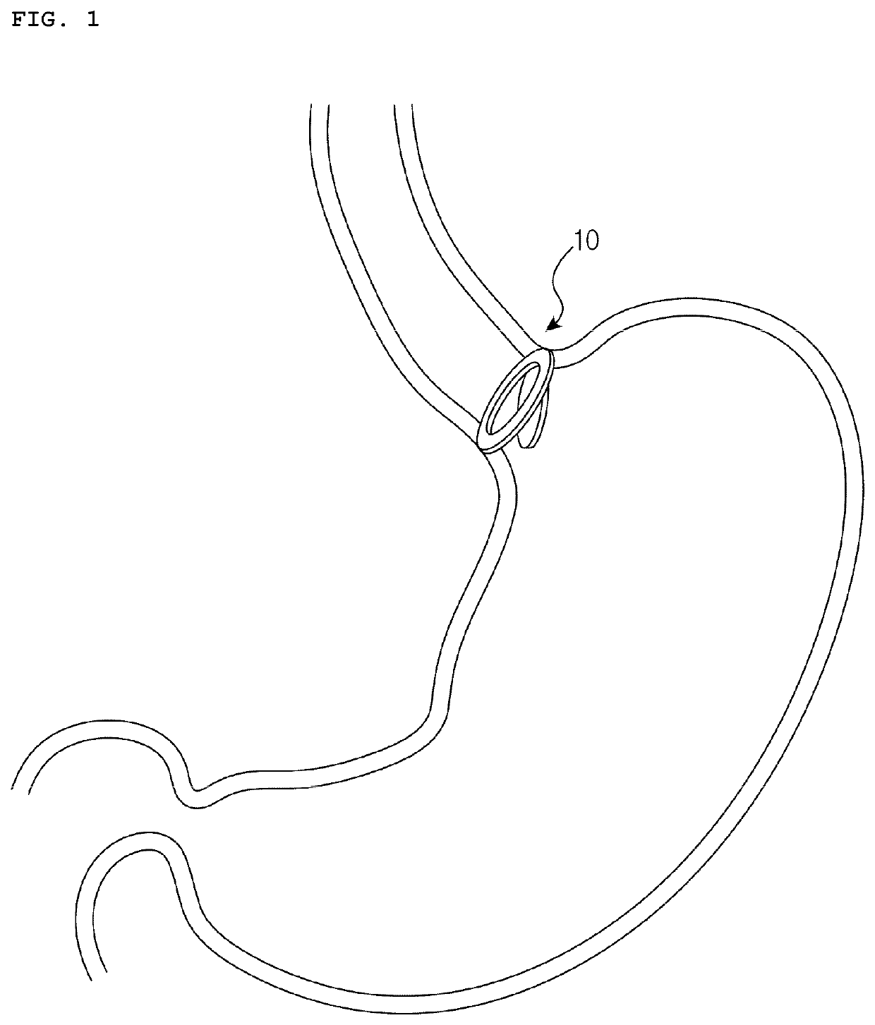 Anti-reflux valve for preventing gastroesophageal reflux disease