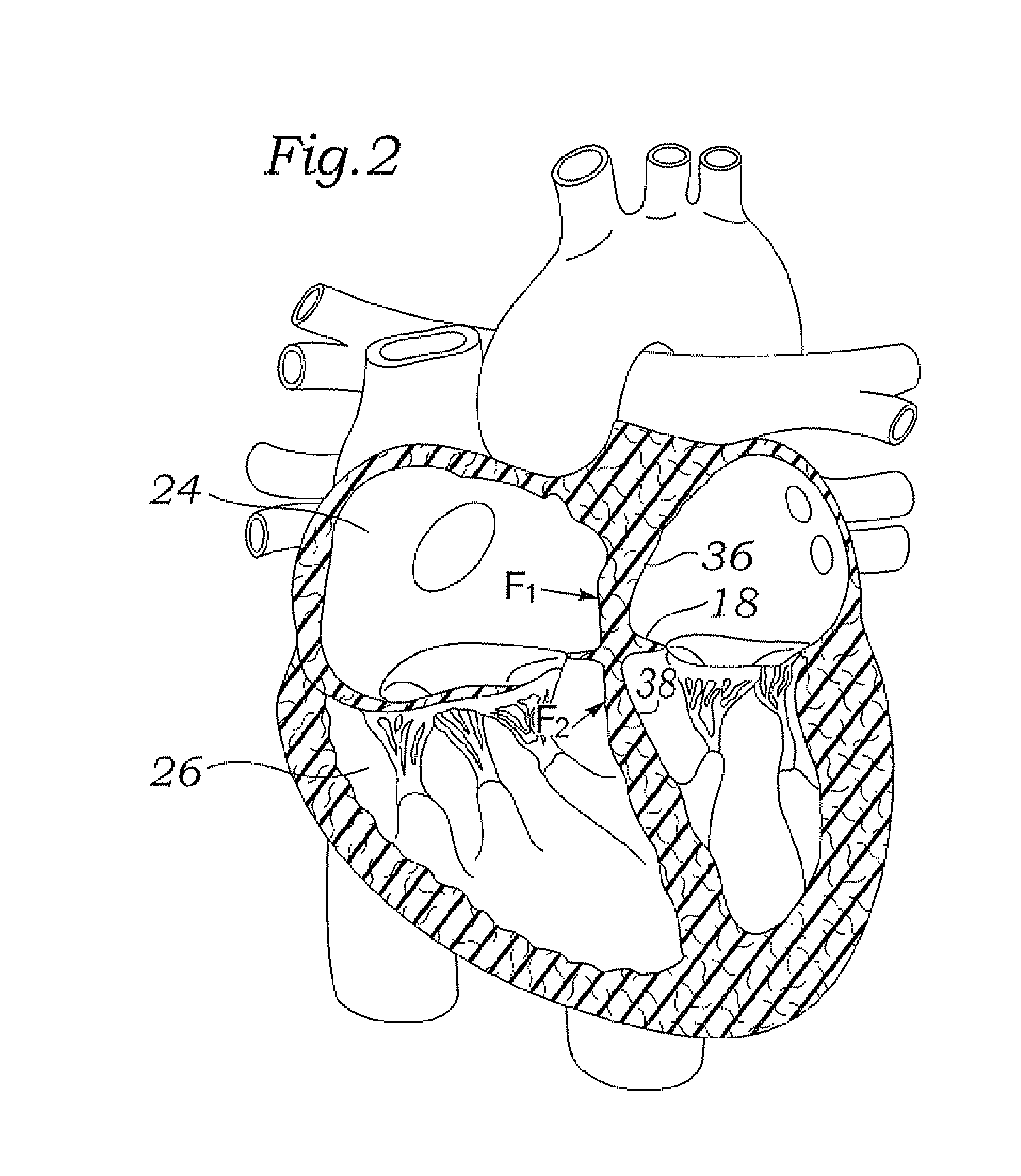 Device and Method for ReShaping Mitral Valve Annulus