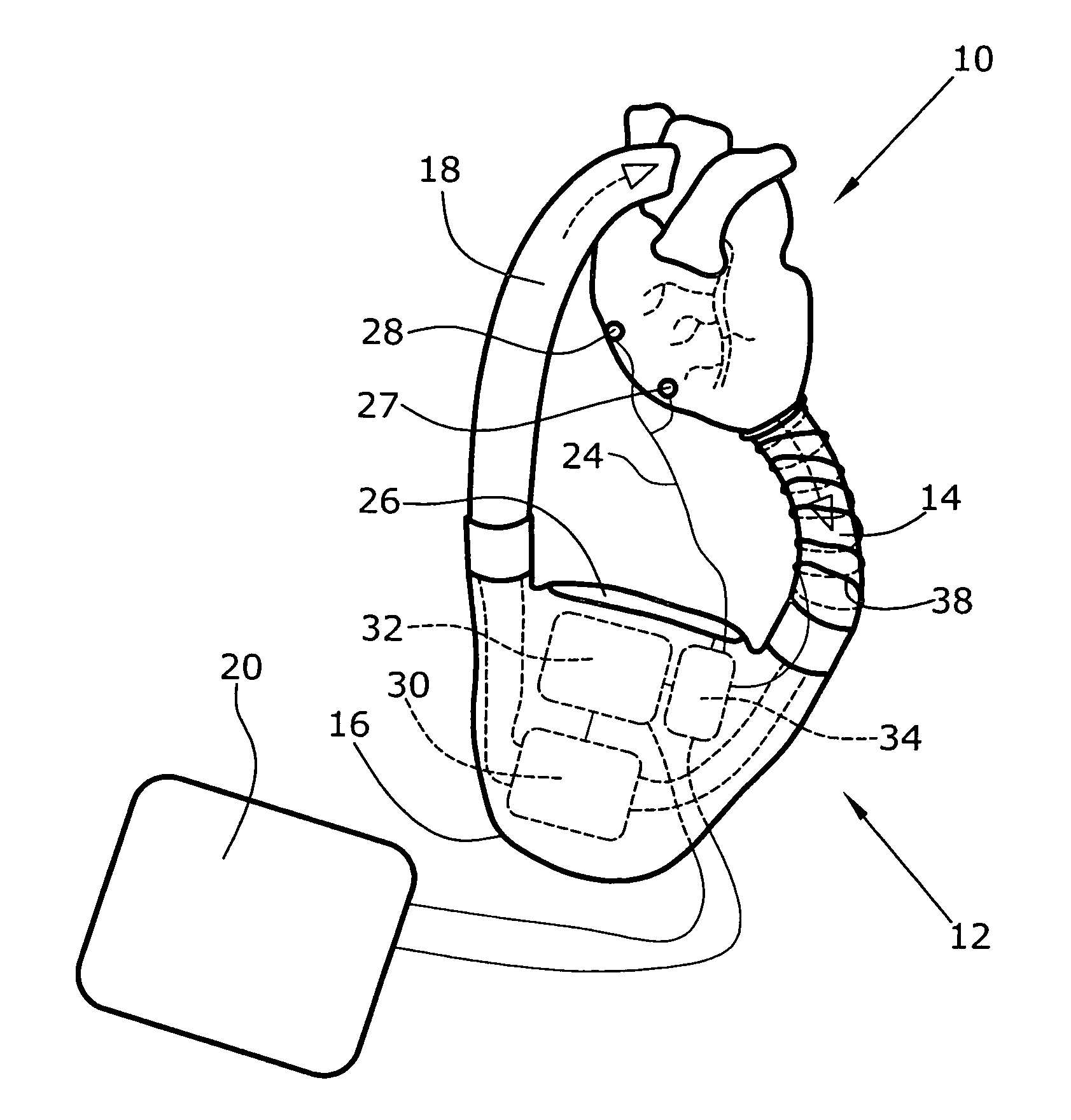 Artificial Heart