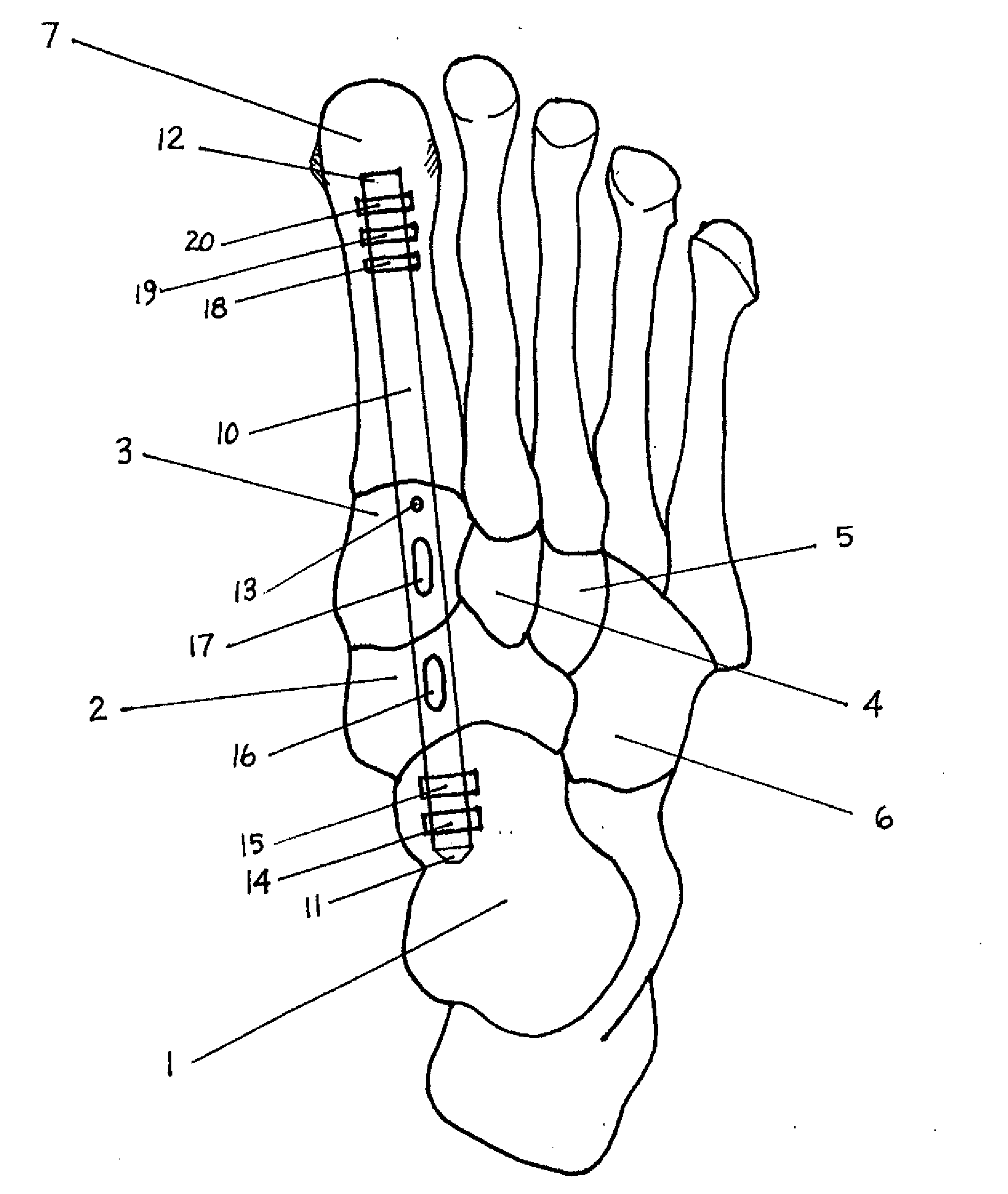 Method and Apparatus for Repairing the Mid-Foot Region Via and Intramedullary Nail