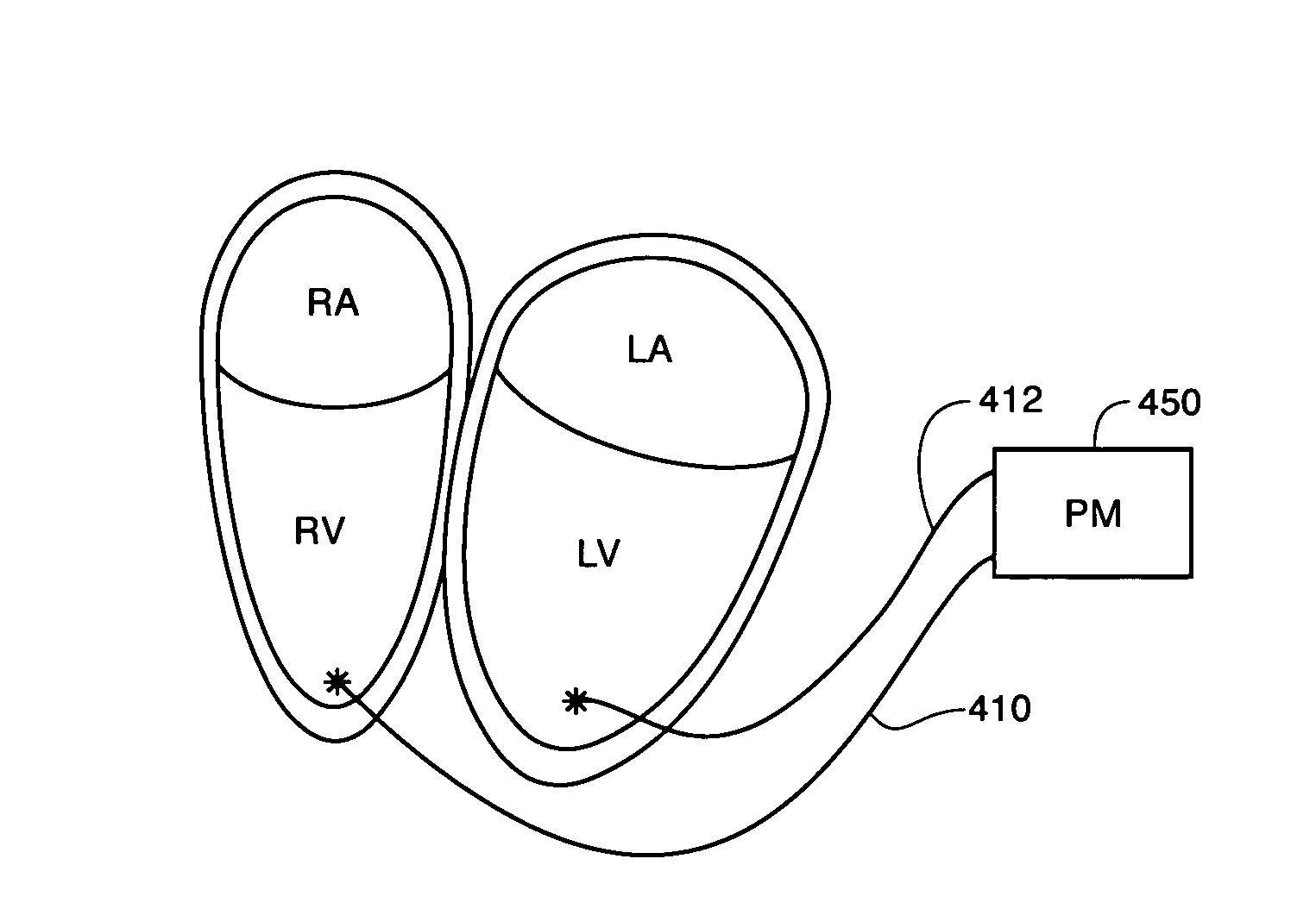 Cardiac stimulation apparatus and method for the control of hypertension