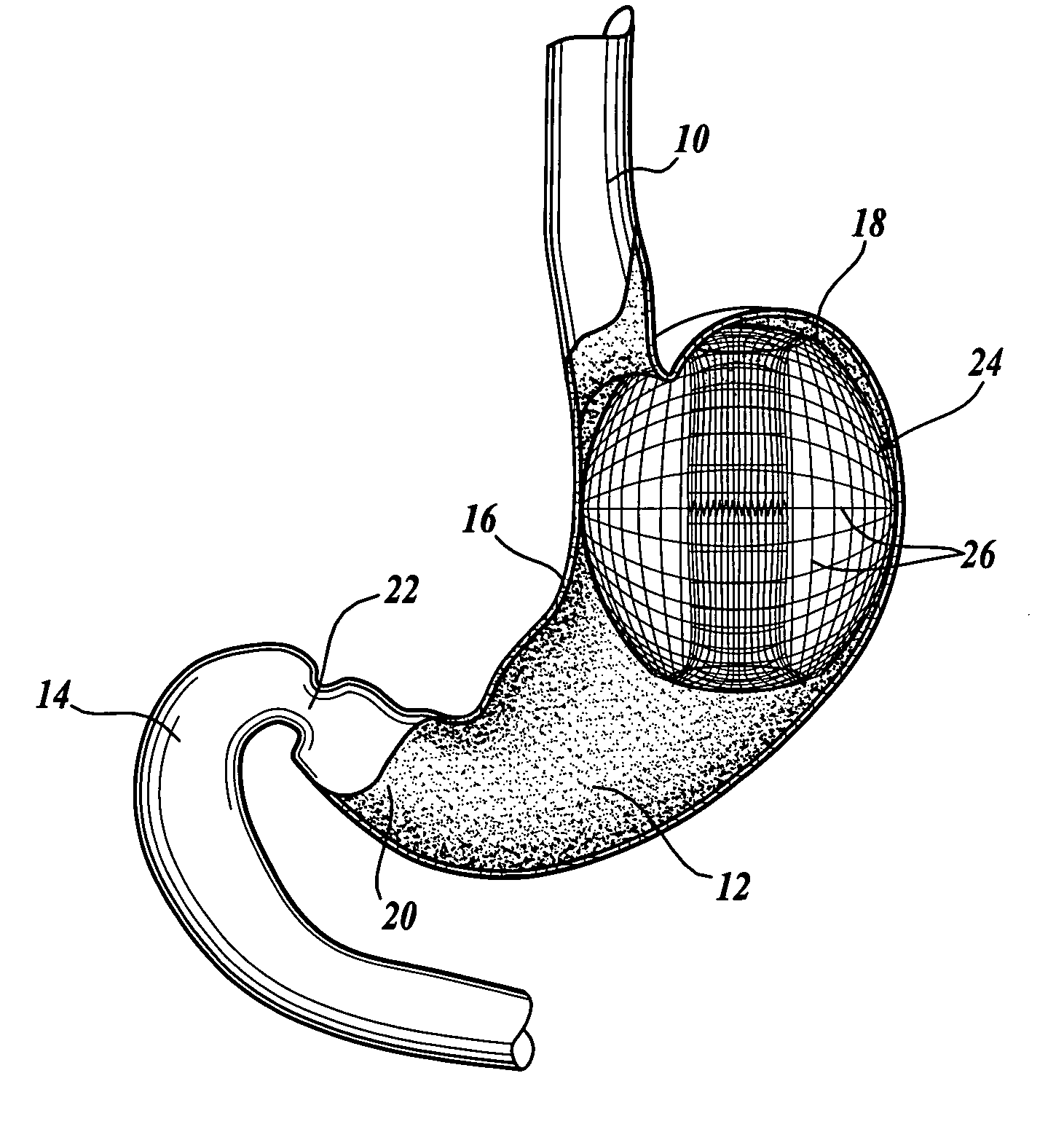 Intragastric prosthesis for the treatment of morbid obesity
