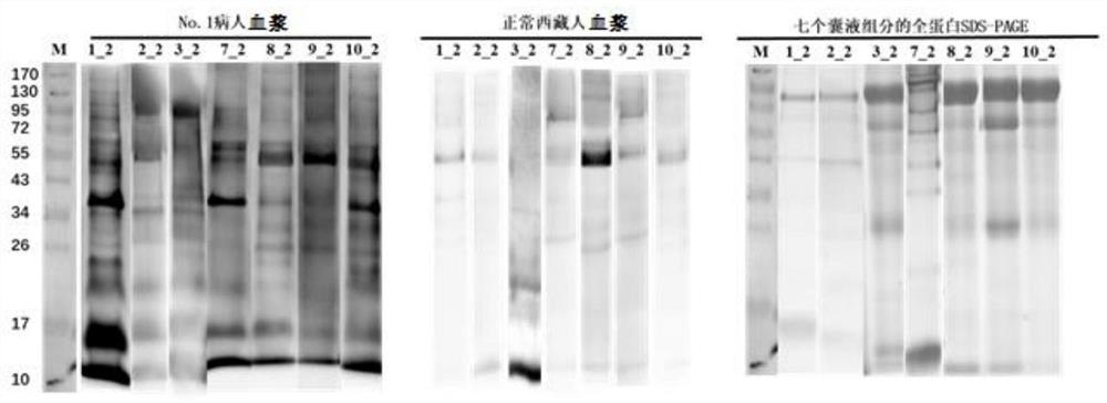 Recombinant protein of human echinococcosis antigen and application thereof