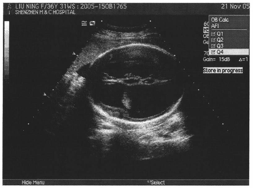 Image processing method for automatically judging fetal hydrocephalus from ultrasonic images