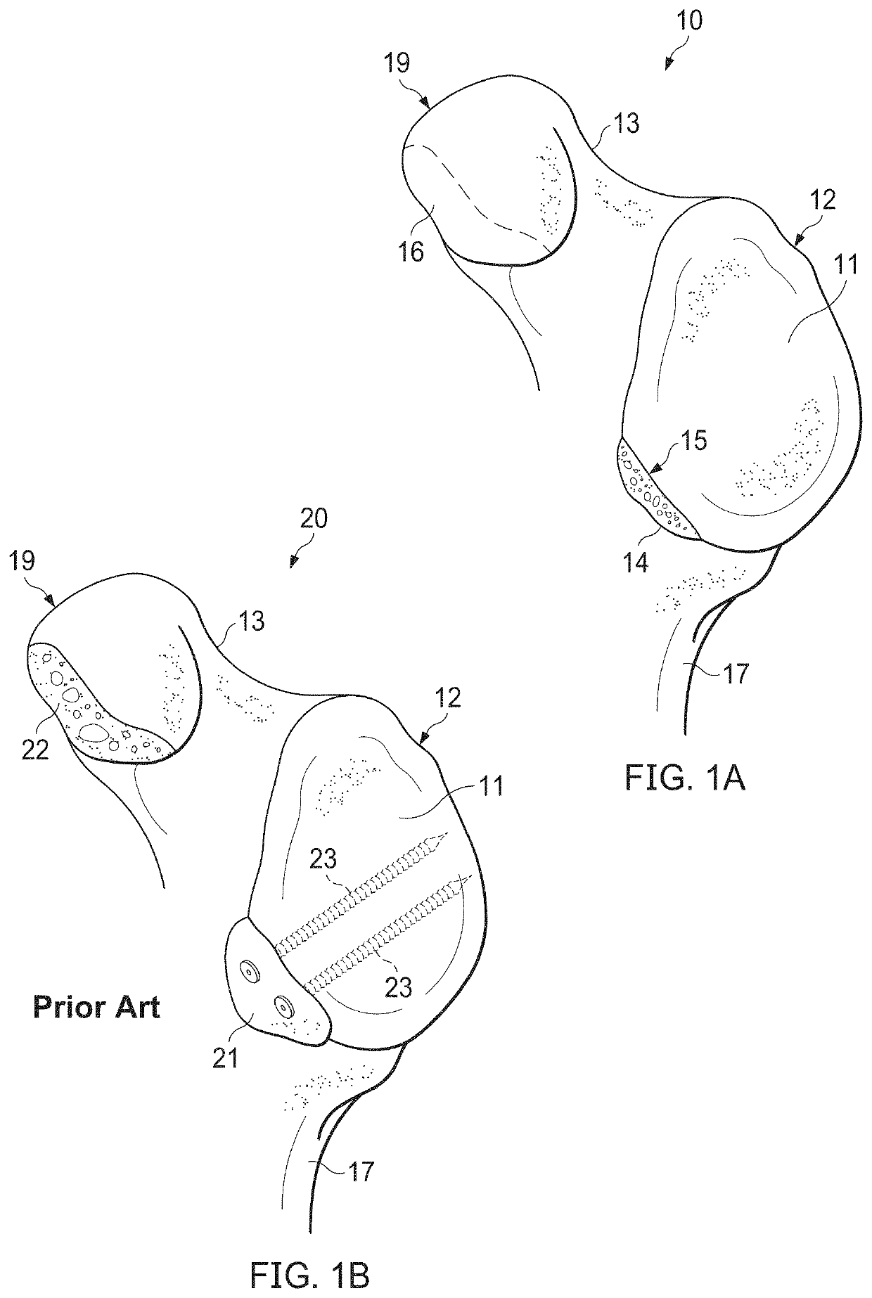 Glenoid bone graft retention plate