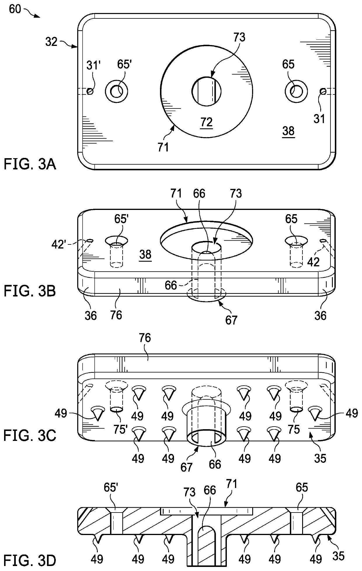 Glenoid bone graft retention plate