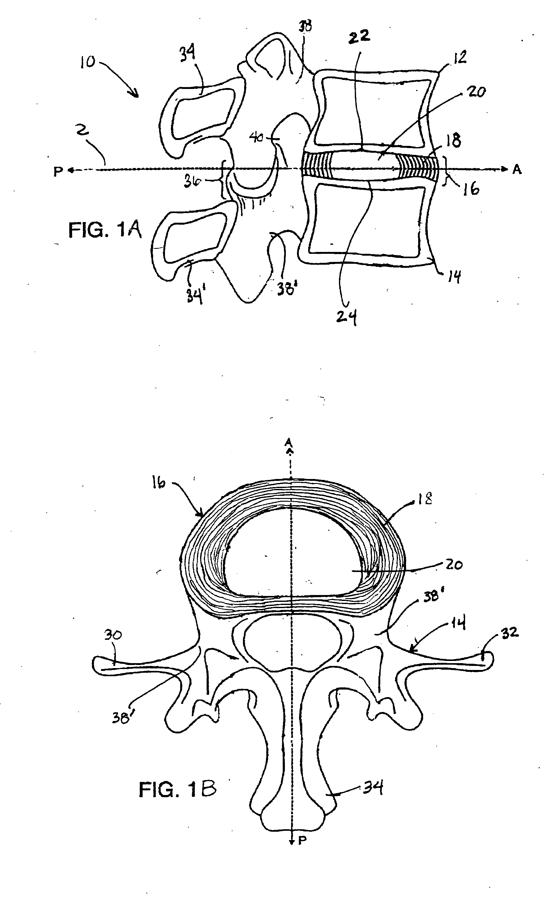 Systems and methods for augmenting intervertebral discs