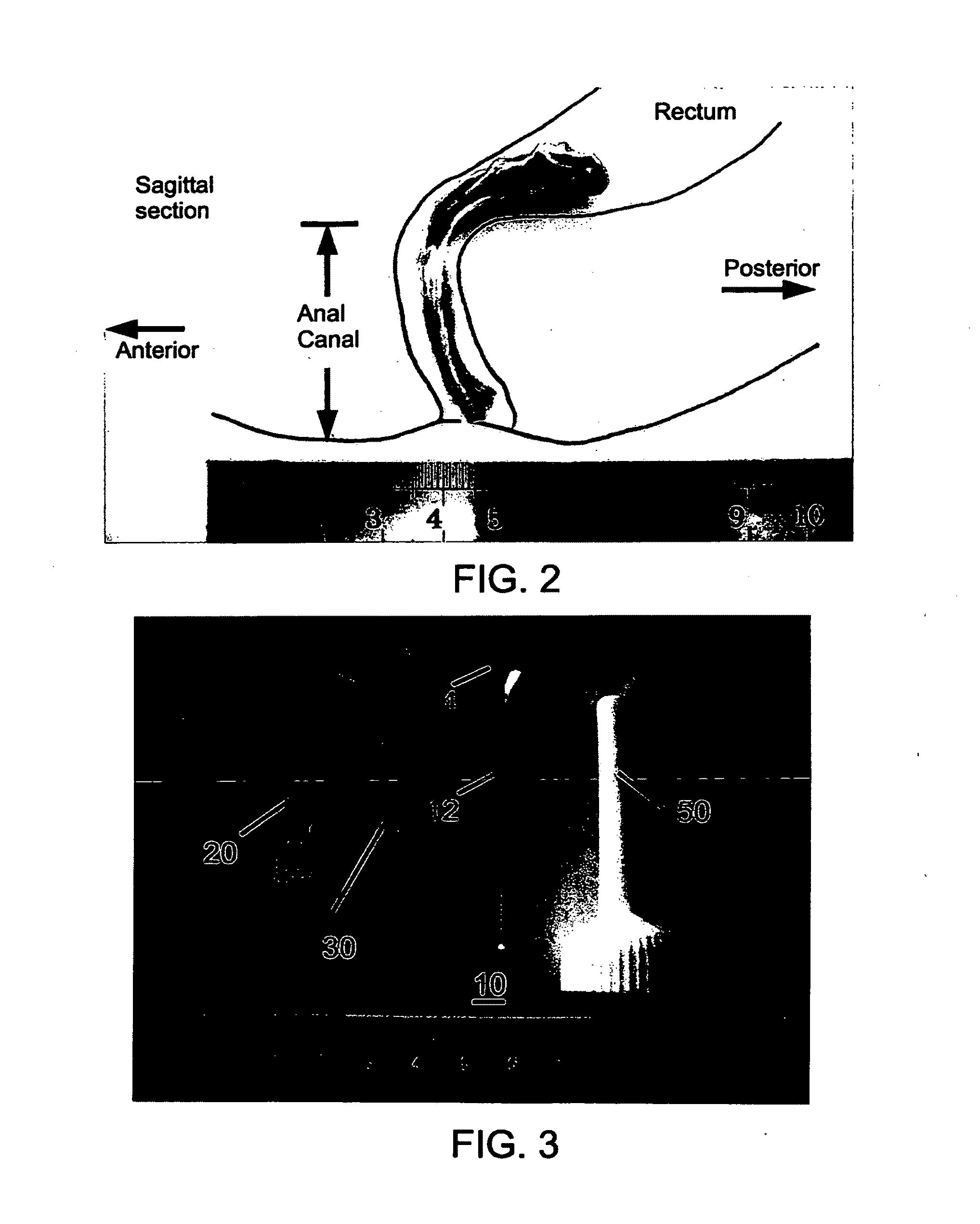 Fecal incontinence device, system and method