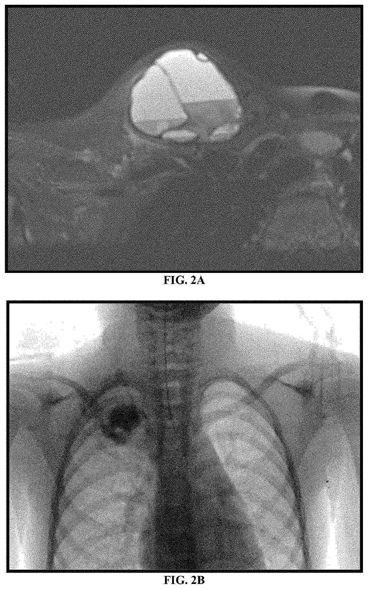 System and Method for Treatment of Bone