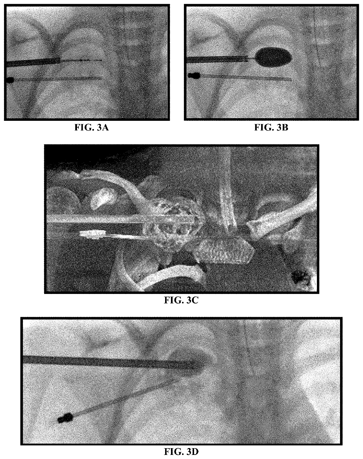 System and Method for Treatment of Bone