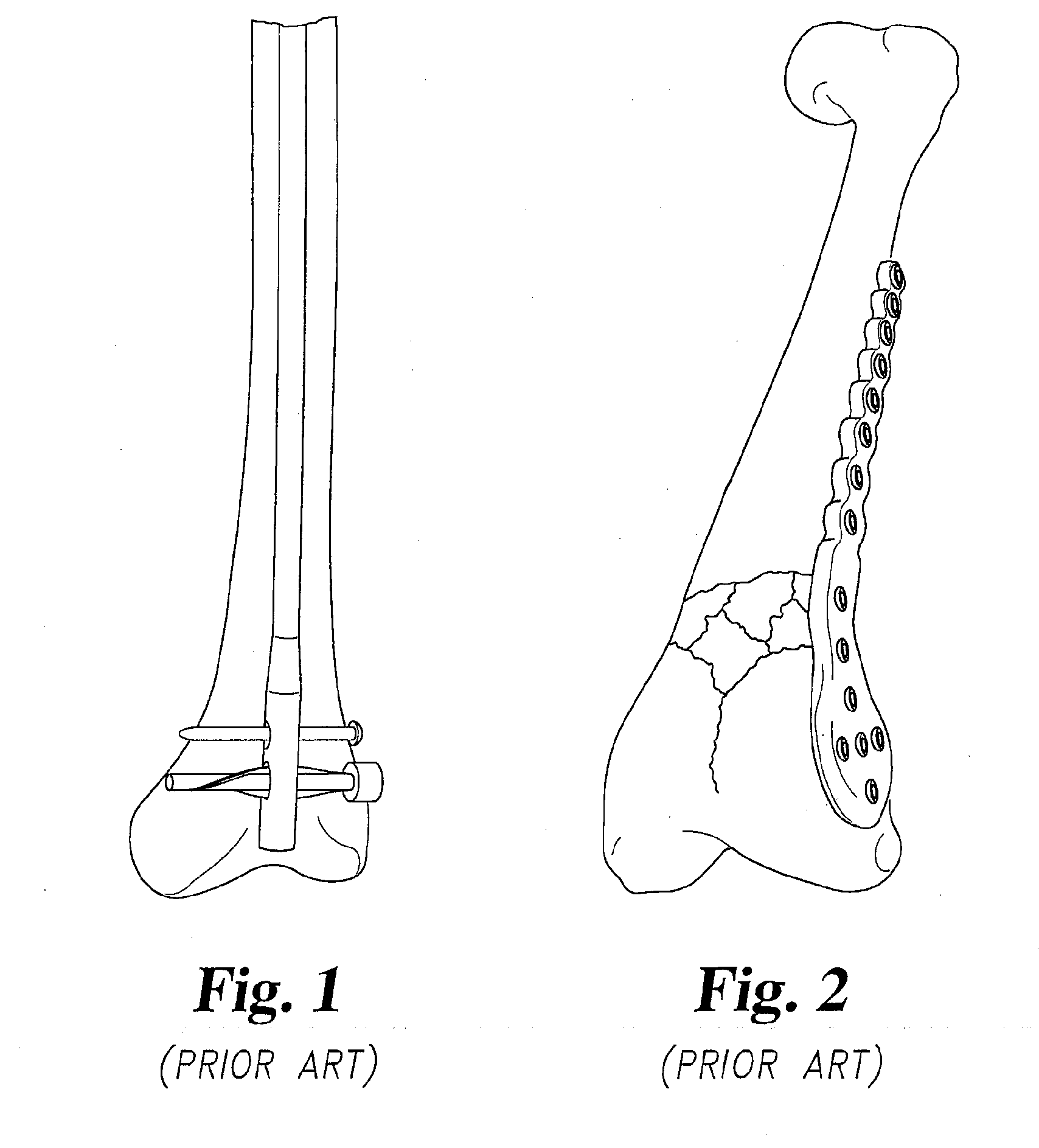 Long bone fixation system and methods