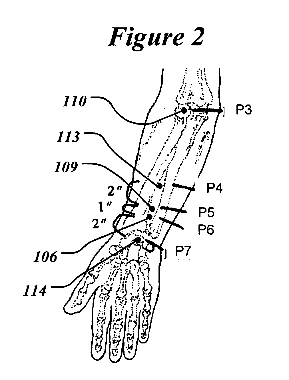Implantable device and method for treatment of hypertension