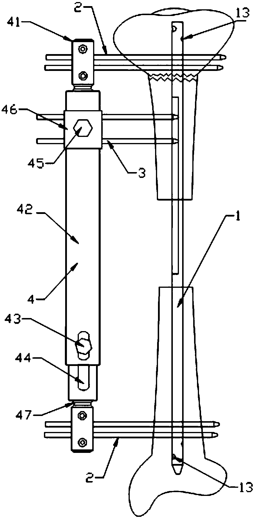 A bone-handling device for large segmental bone defects of the tibia