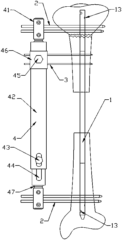 A bone-handling device for large segmental bone defects of the tibia