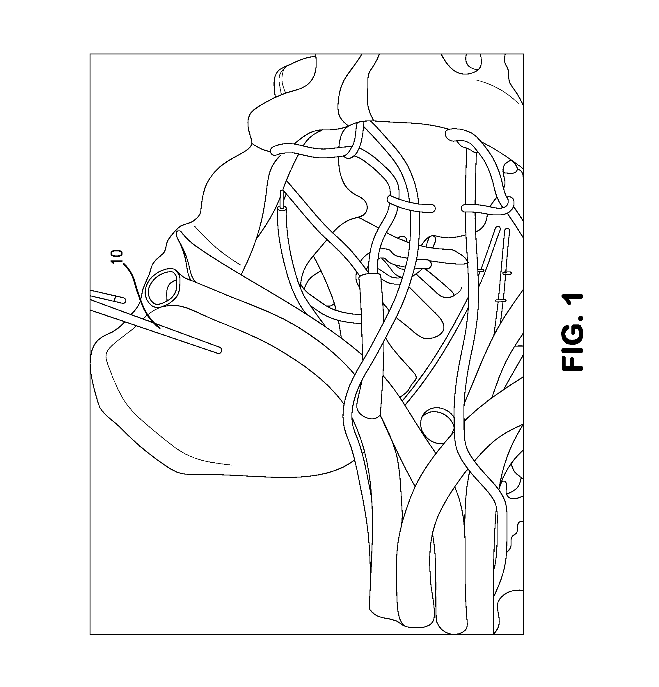 System and method for implantation of lead and electrodes to the endopelvic portion of the pelvic nerves to treat pelvic floor/organ dysfunctions and pelvic neuropathic pain
