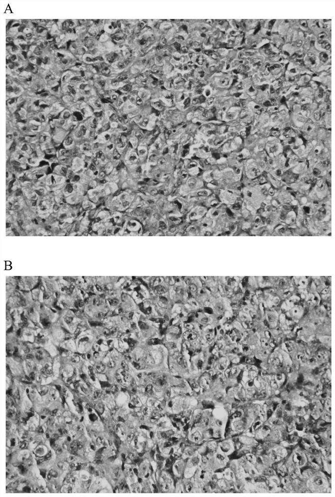 A human epidermal growth factor tyrosine kinase inhibitor acquired drug-resistant lung cancer cell line and its establishment method and application