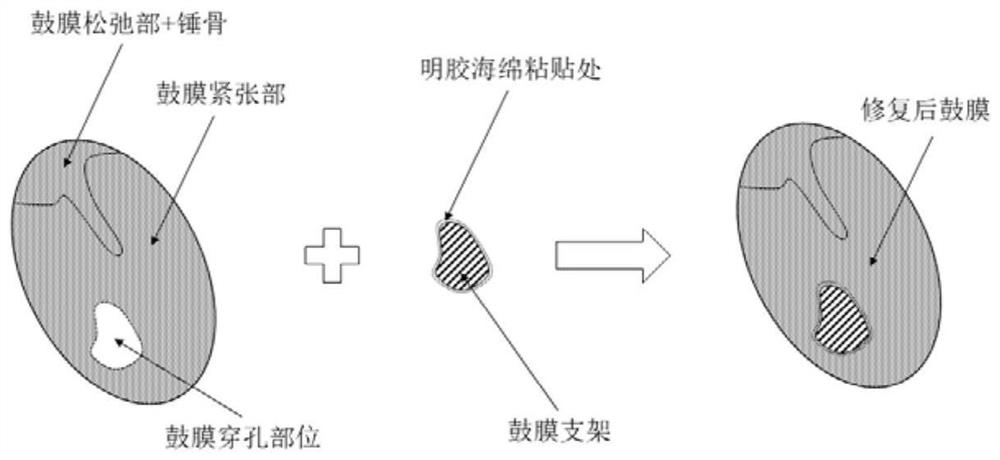 Tympanic membrane repair stent material, preparation method and preparation method of tympanic membrane repair stent