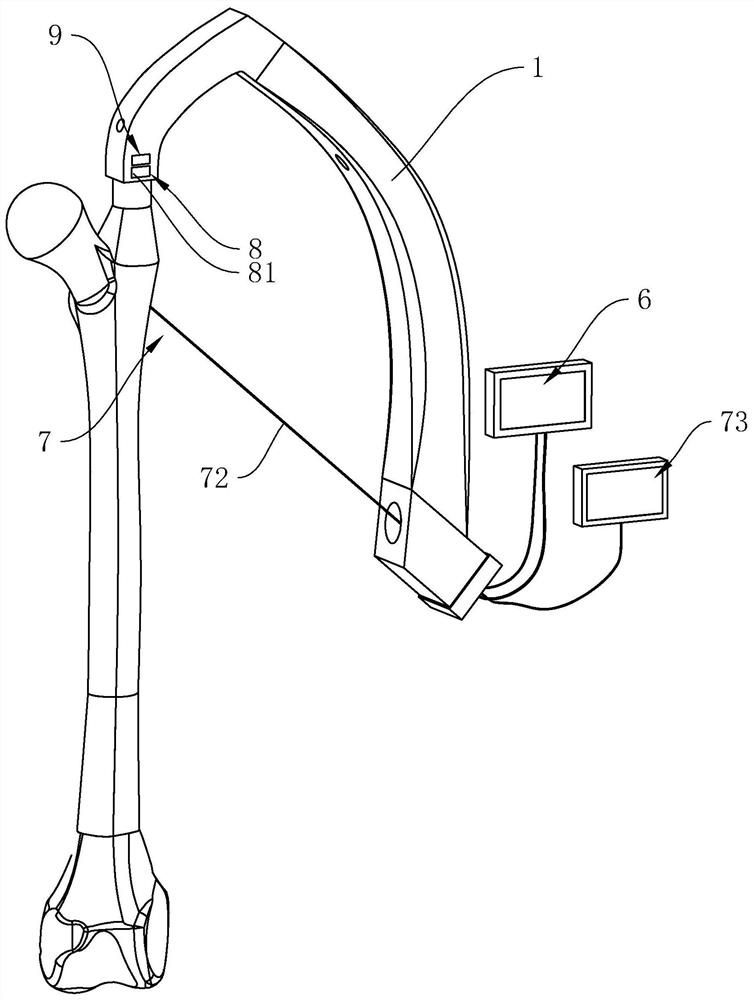 Fracture intramedullary fixation device and method