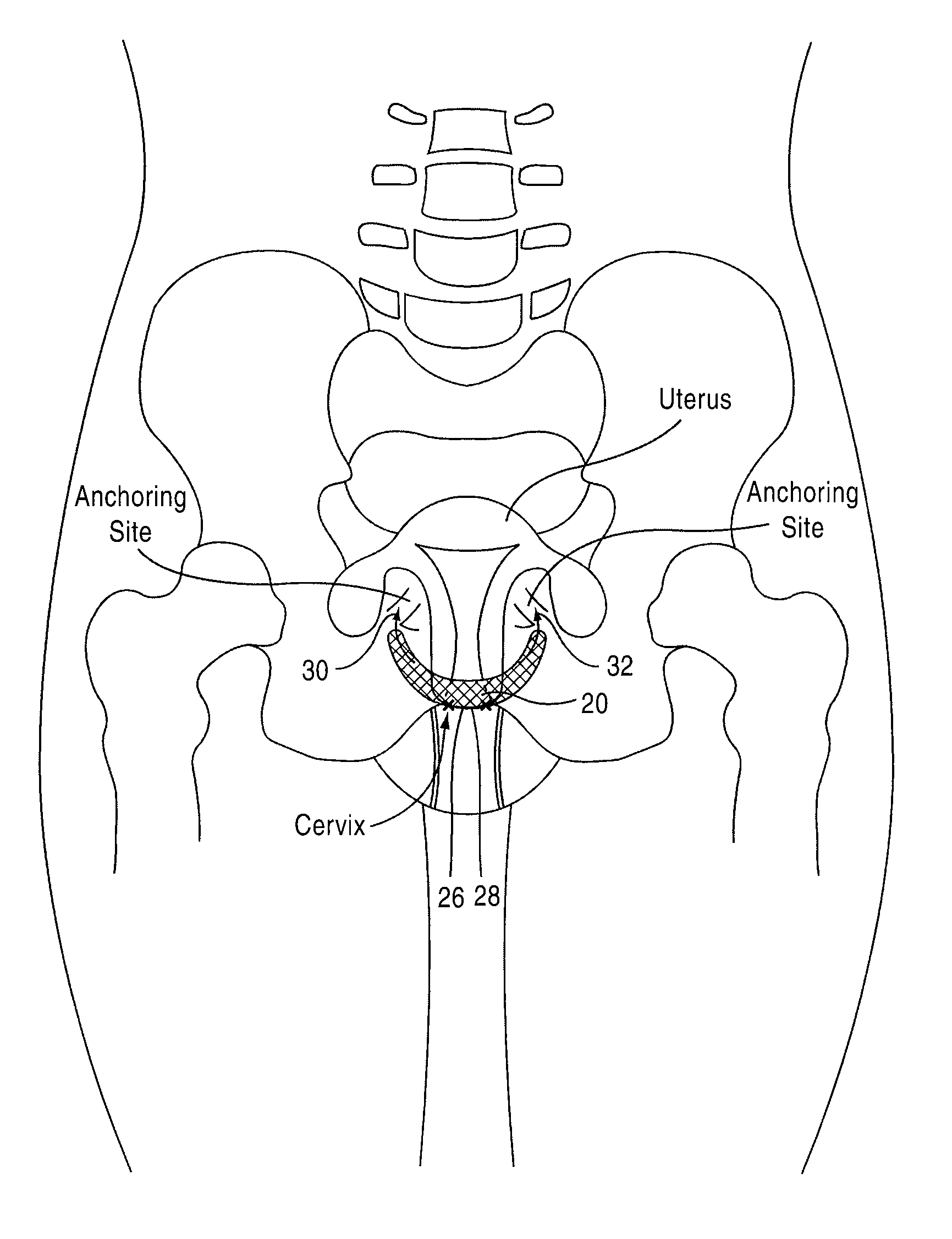 Apparatus and method for suspending a uterus