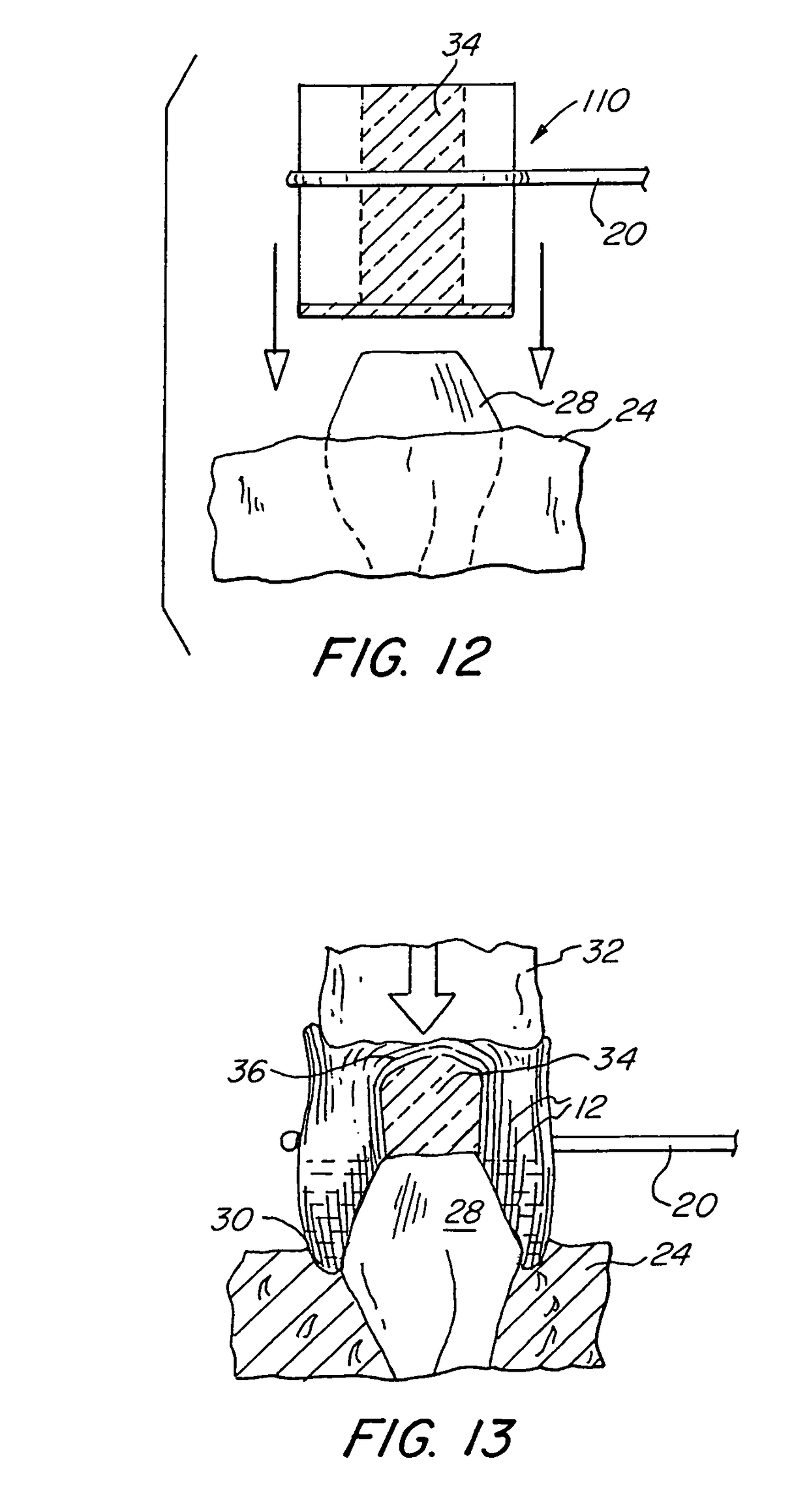 Conforming gingiva retraction compression cap and method of retracting tissue around a tooth
