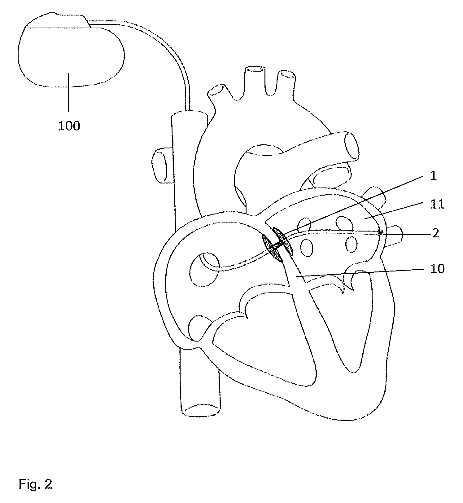 Implantable indifferent reference electrode pole