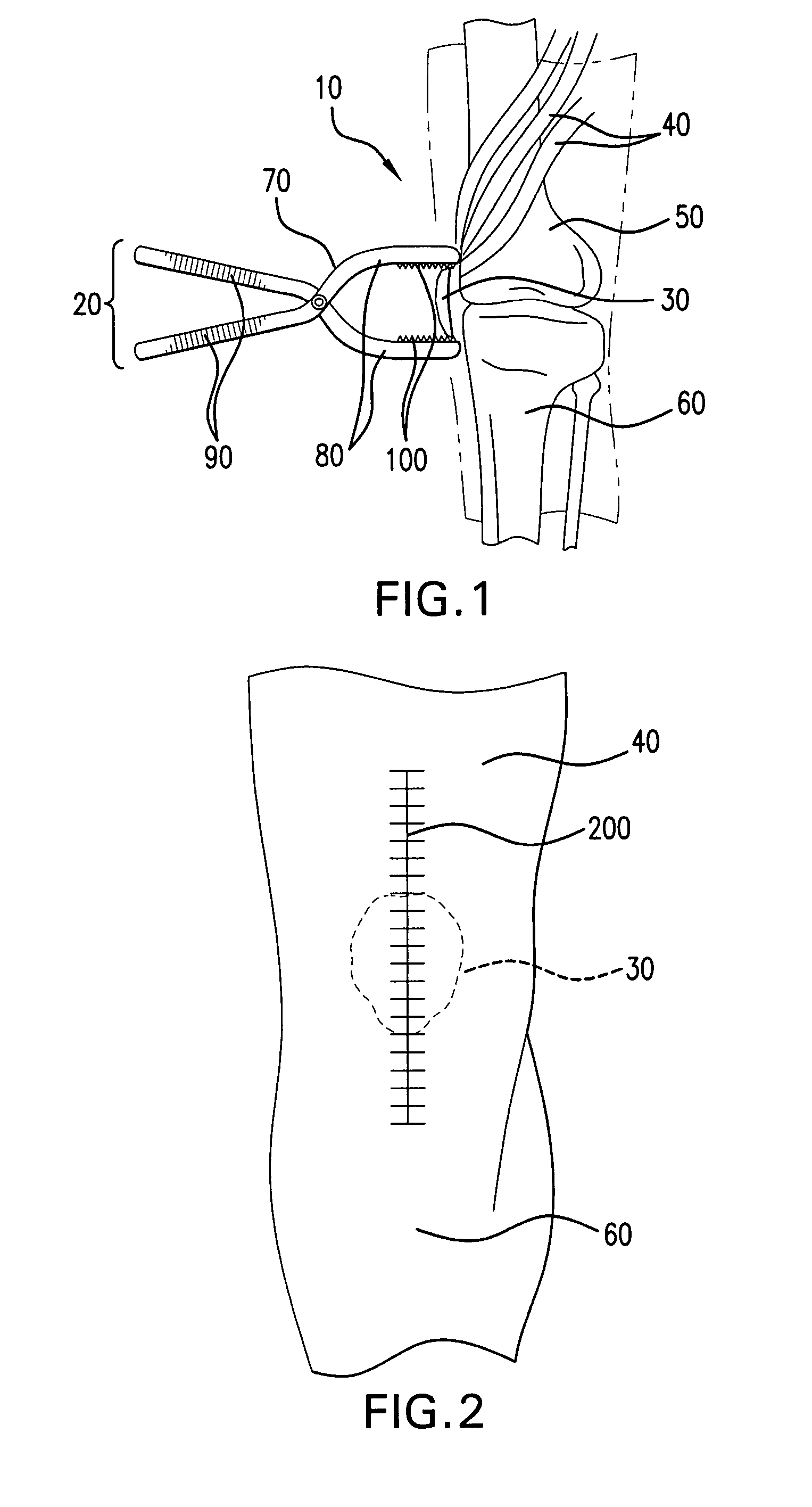 Apparatus and method for implementing patella resection guide during minimally invasive surgery