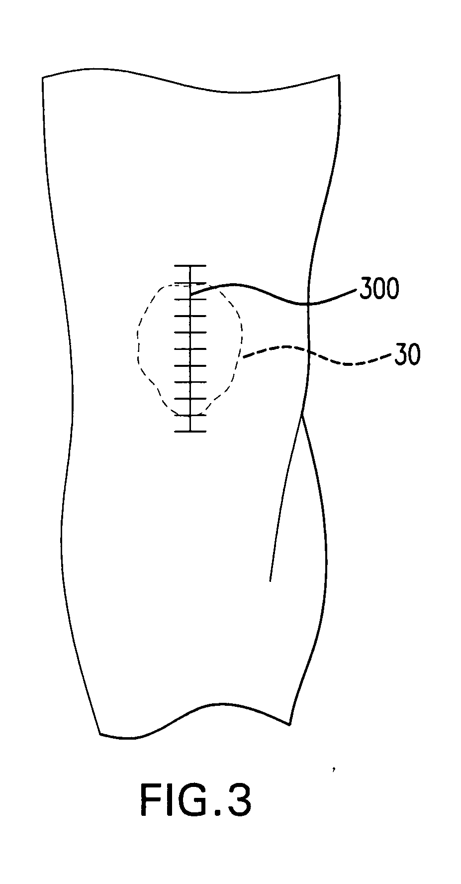 Apparatus and method for implementing patella resection guide during minimally invasive surgery