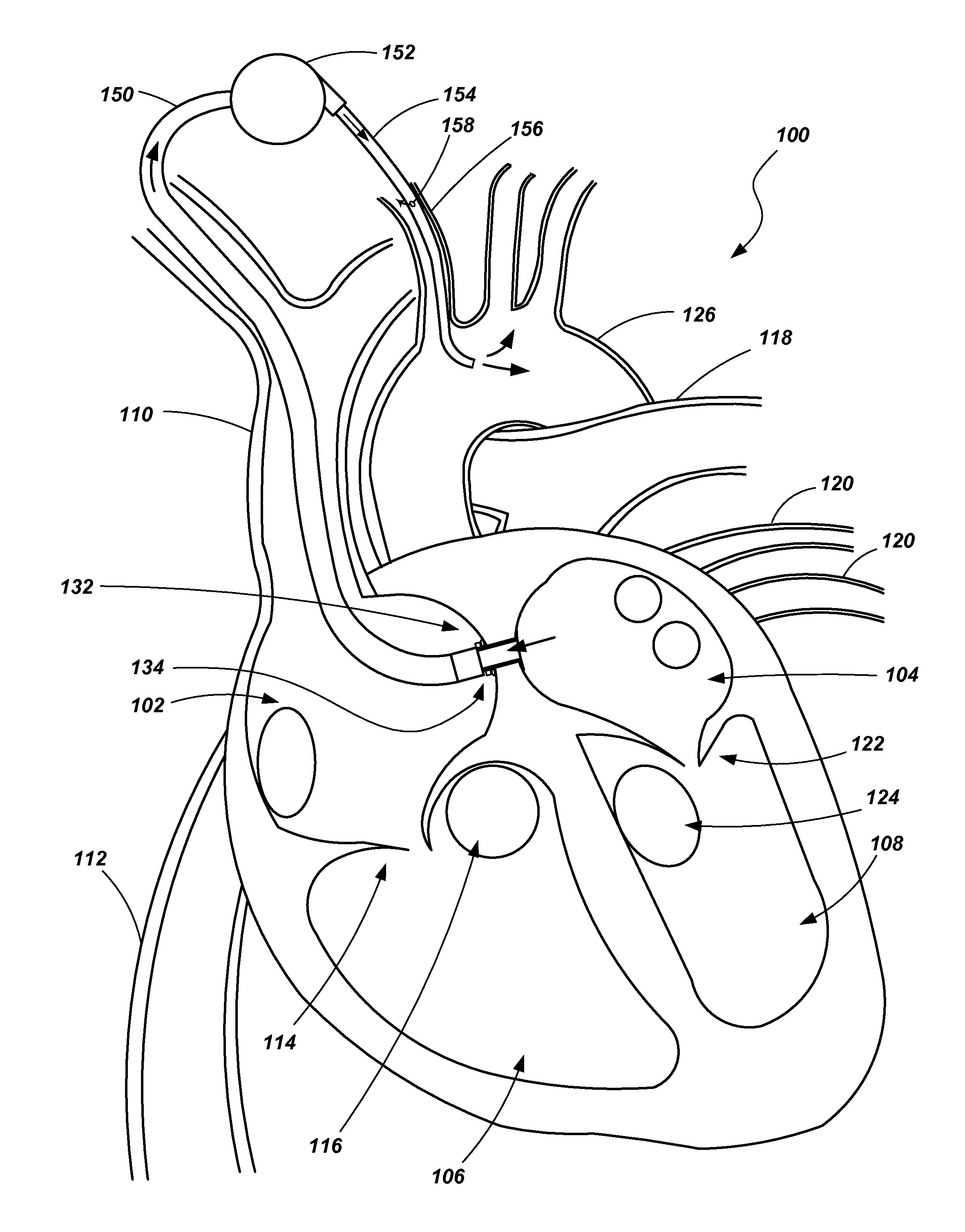 Ventricular assist device and related methods