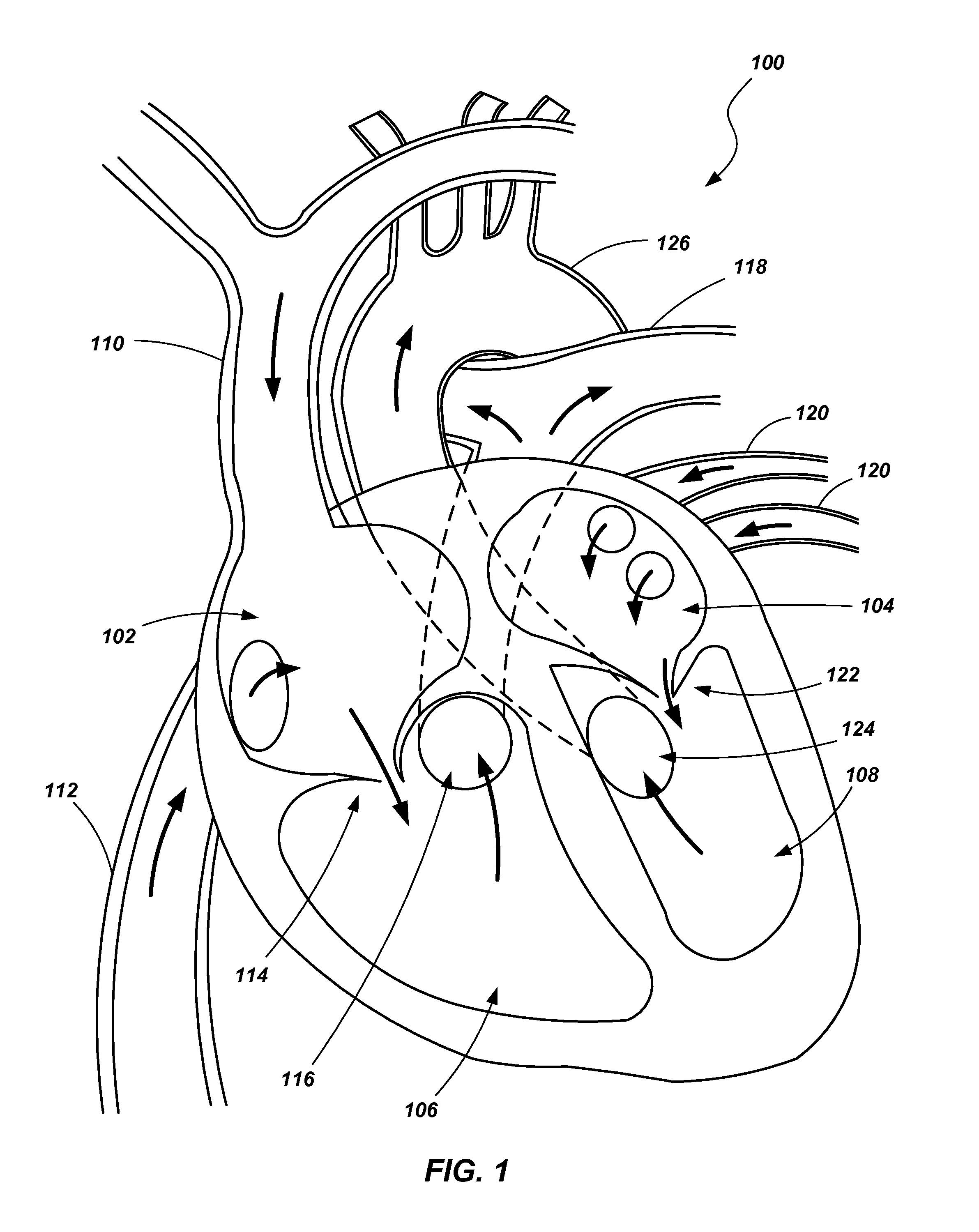 Ventricular assist device and related methods