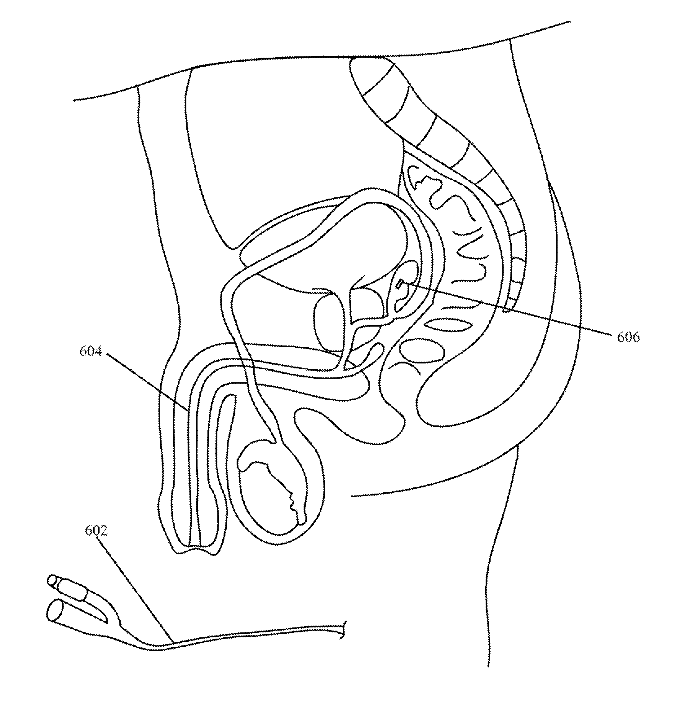 Implantable drug delivery device and methods