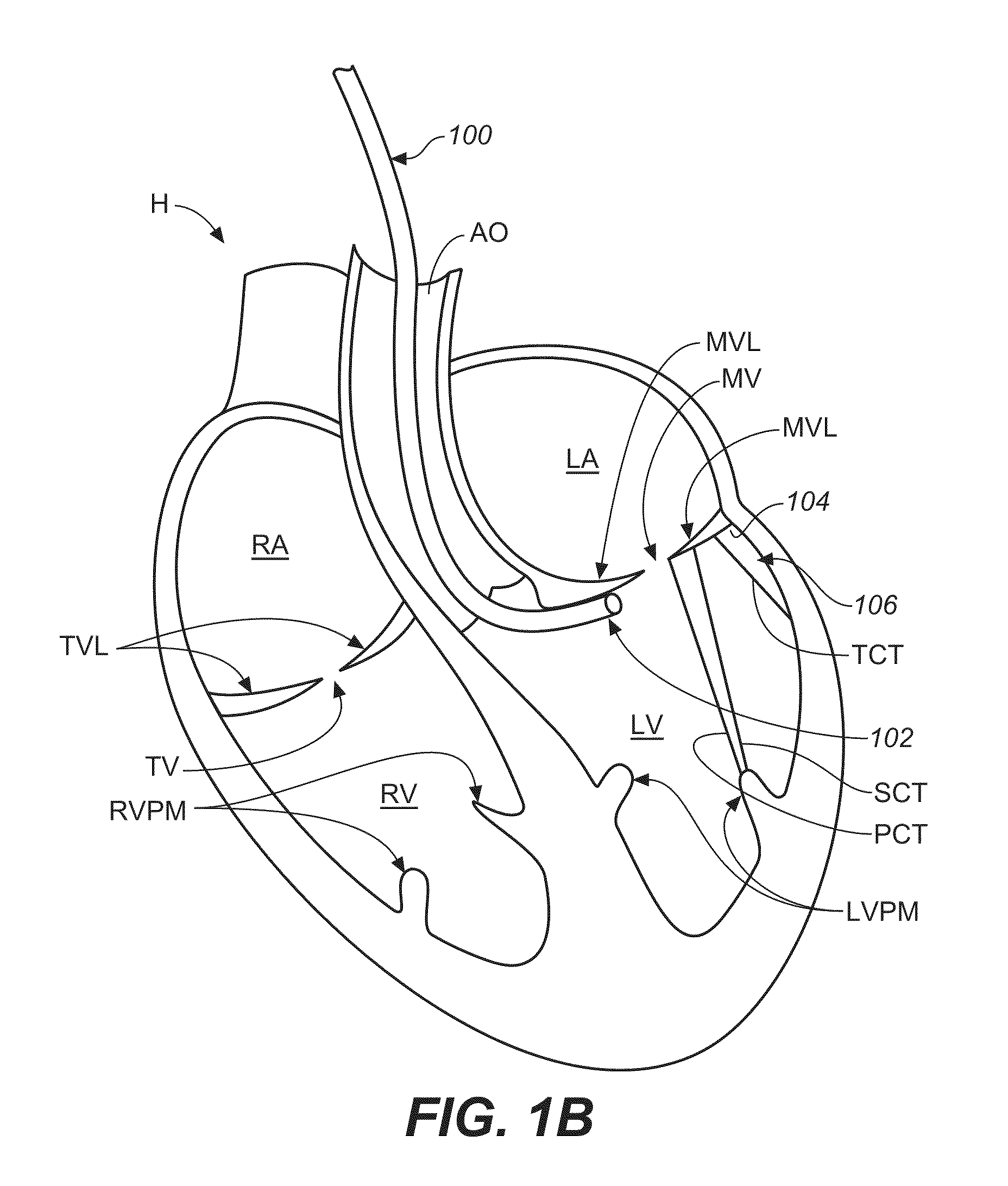 Diagnostic catheters, guide catheters, visualization devices and chord manipulation devices, and related kits and methods