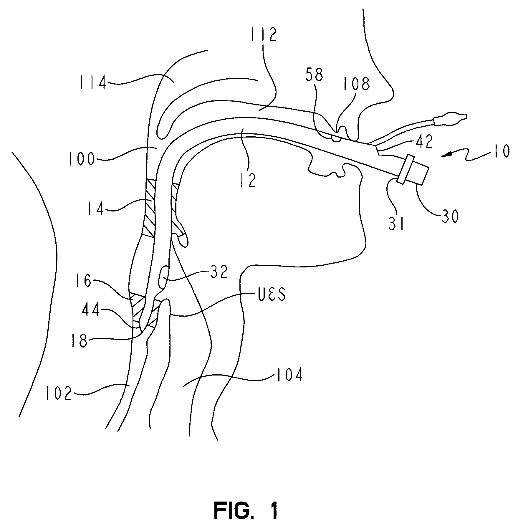 Non-tracheal ventilation tube