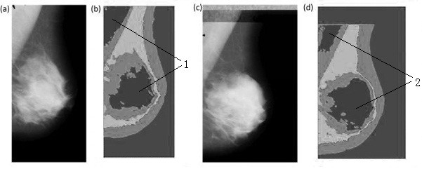 Breast region segmentation and calcification detection method in mammography images