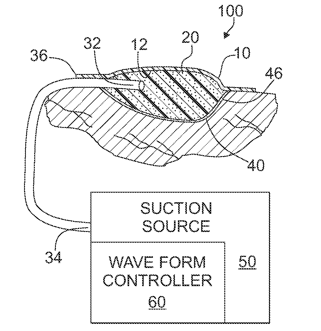 Apparatus and method for wound treatment employing periodic sub-atmospheric pressure