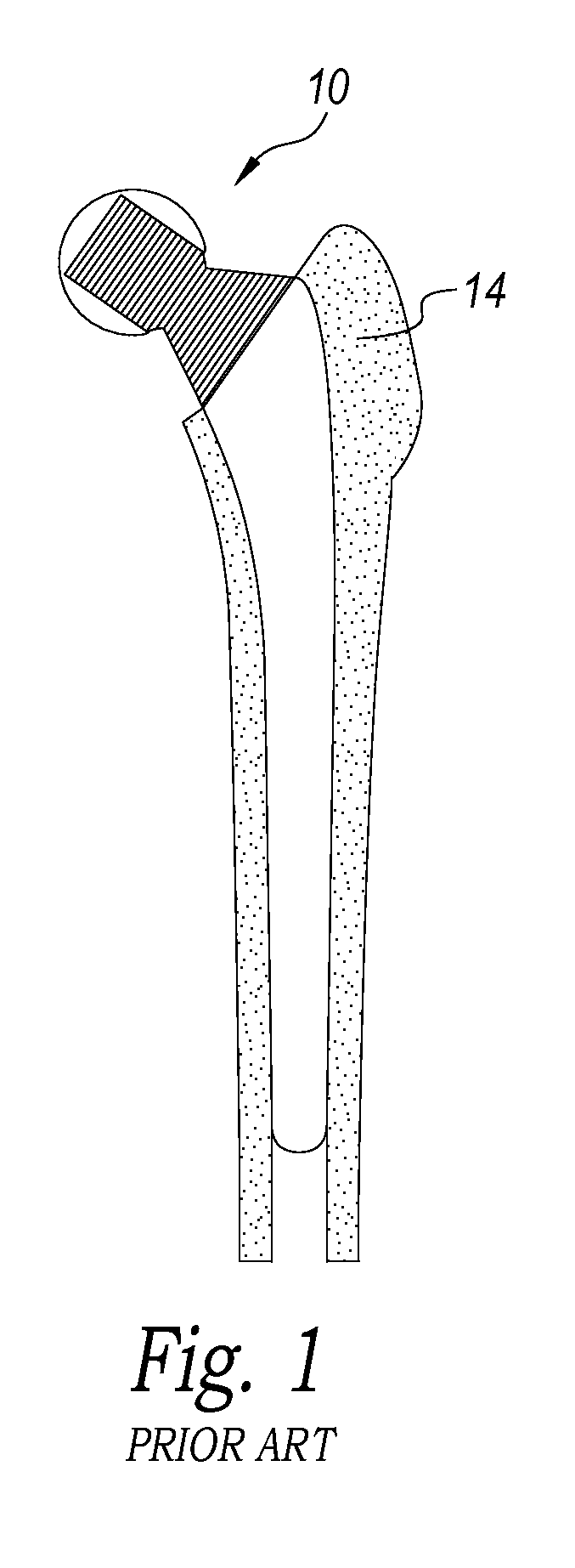 Load bearing implants with engineered gradient stiffness and associated systems and methods