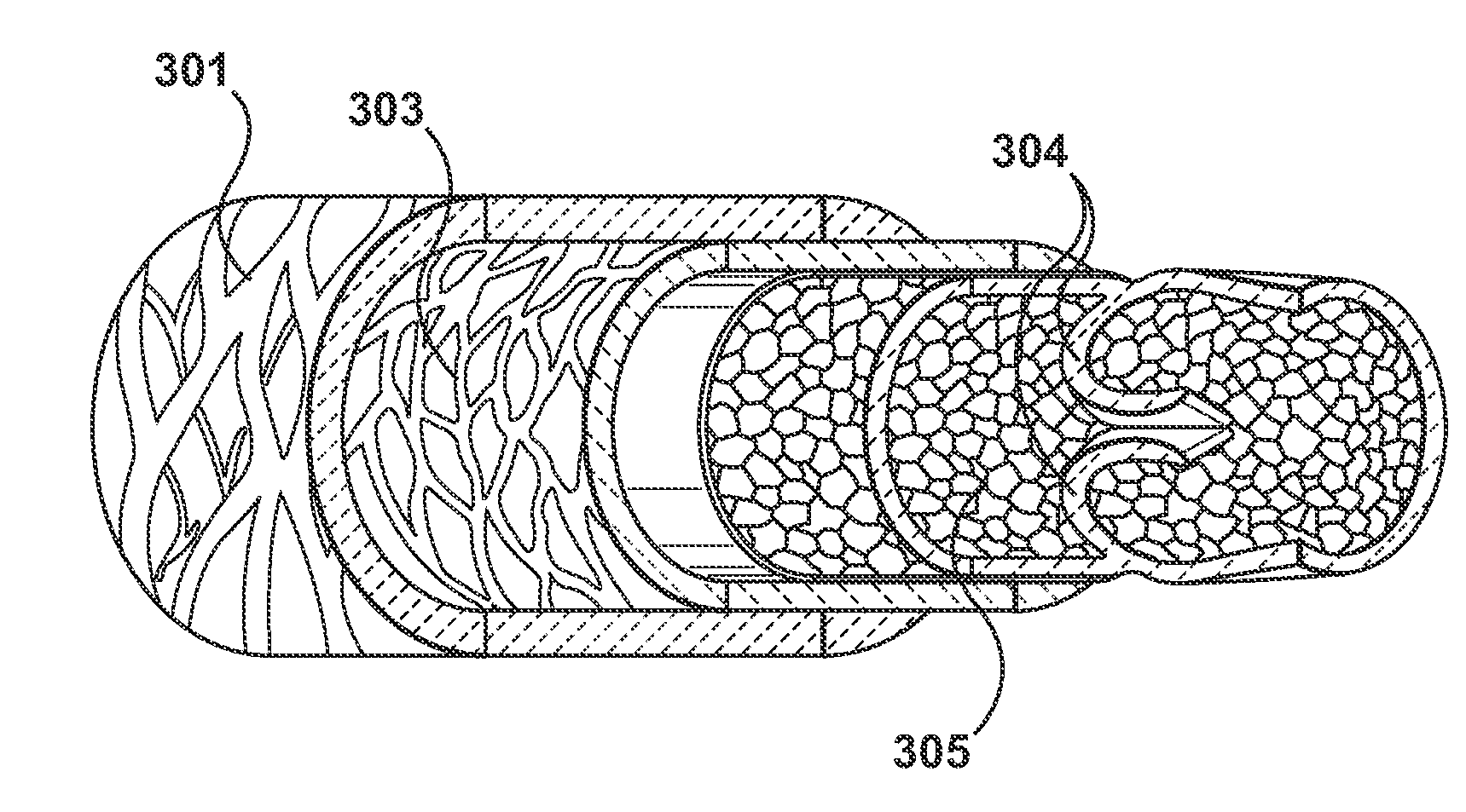 Percutaneous Methods and Apparatus for Creating Native Tissue Venous Valves