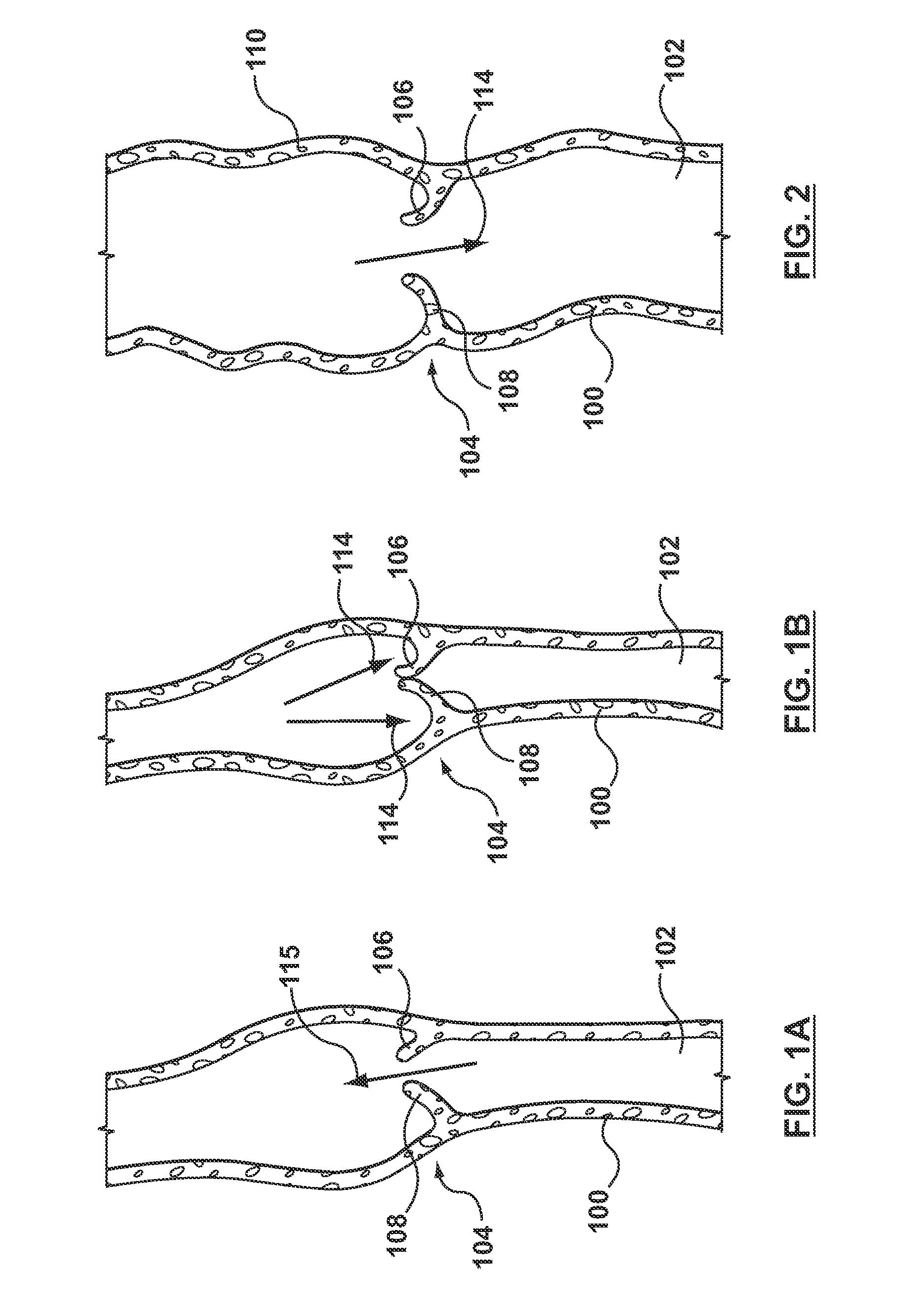 Percutaneous Methods and Apparatus for Creating Native Tissue Venous Valves