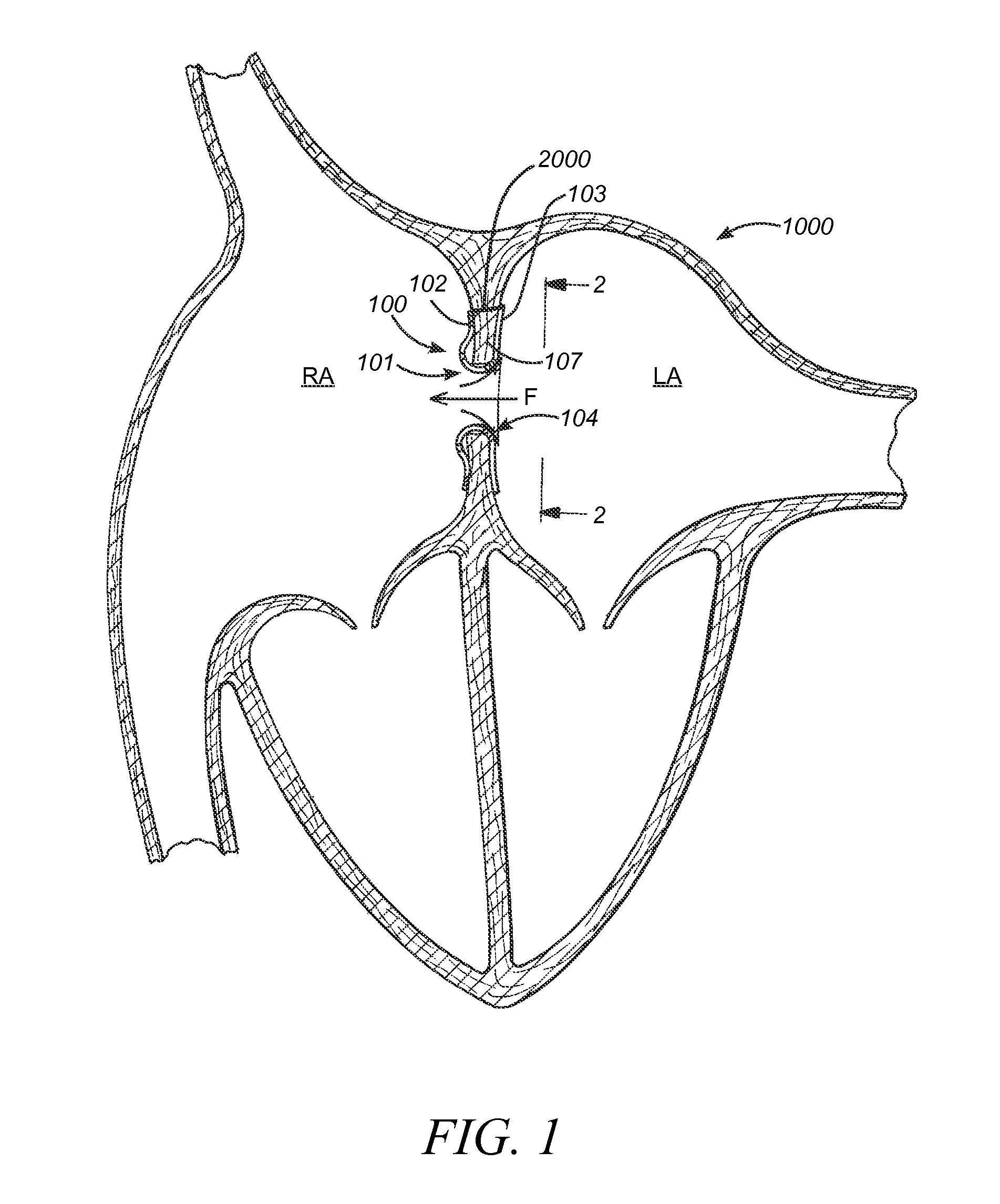 Devices, systems and methods to treat heart failure