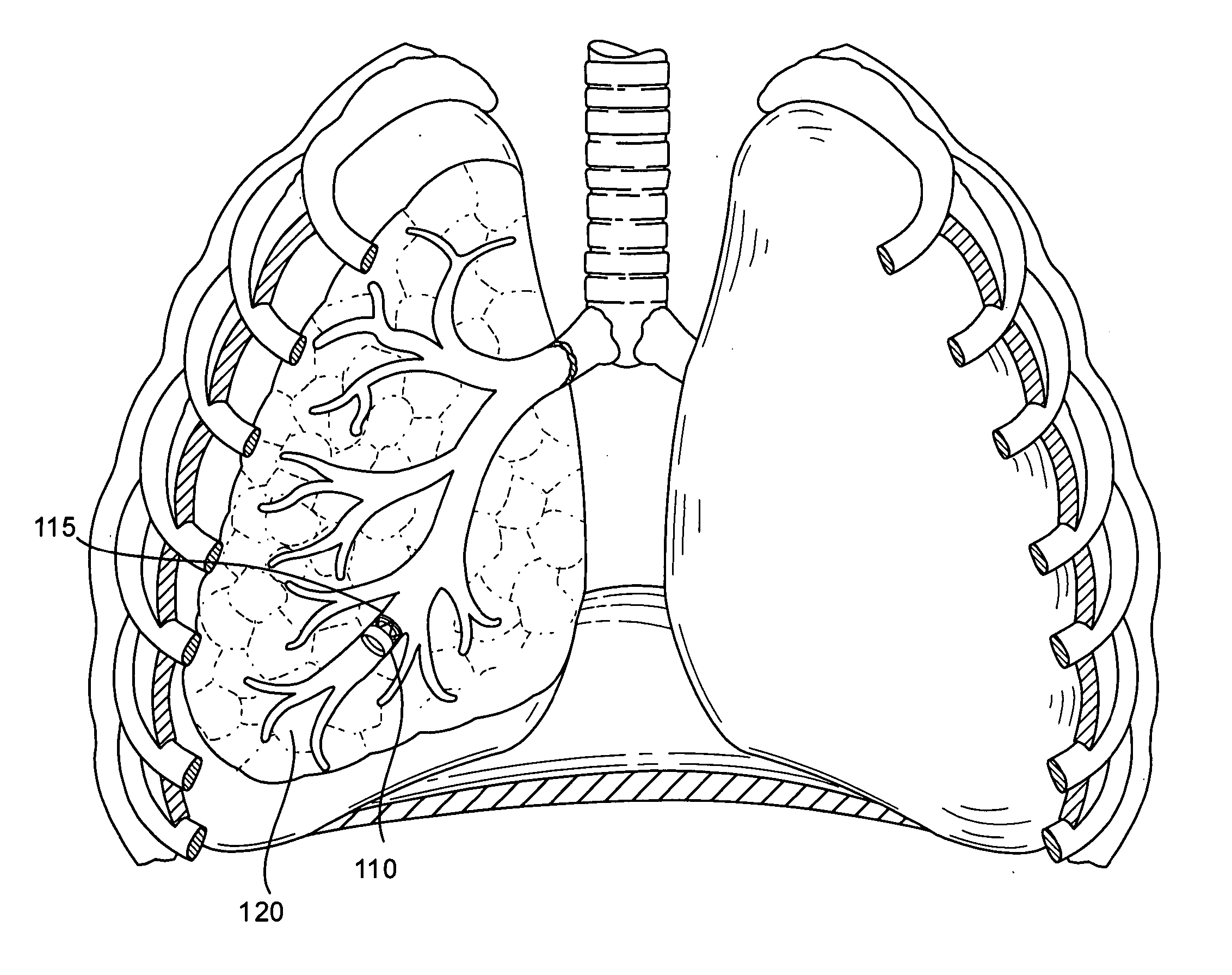 Implanted bronchial isolation devices and methods