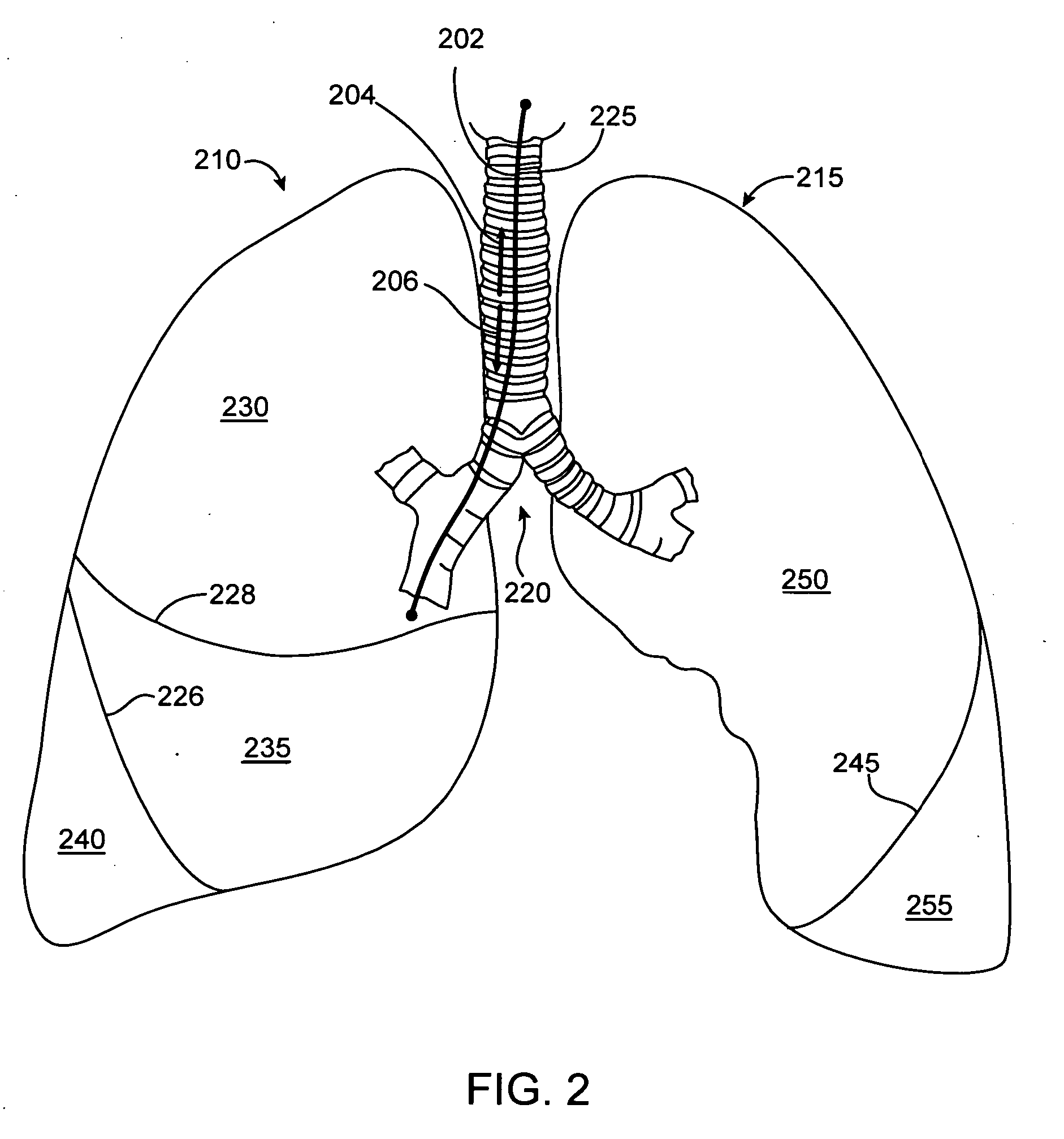 Implanted bronchial isolation devices and methods