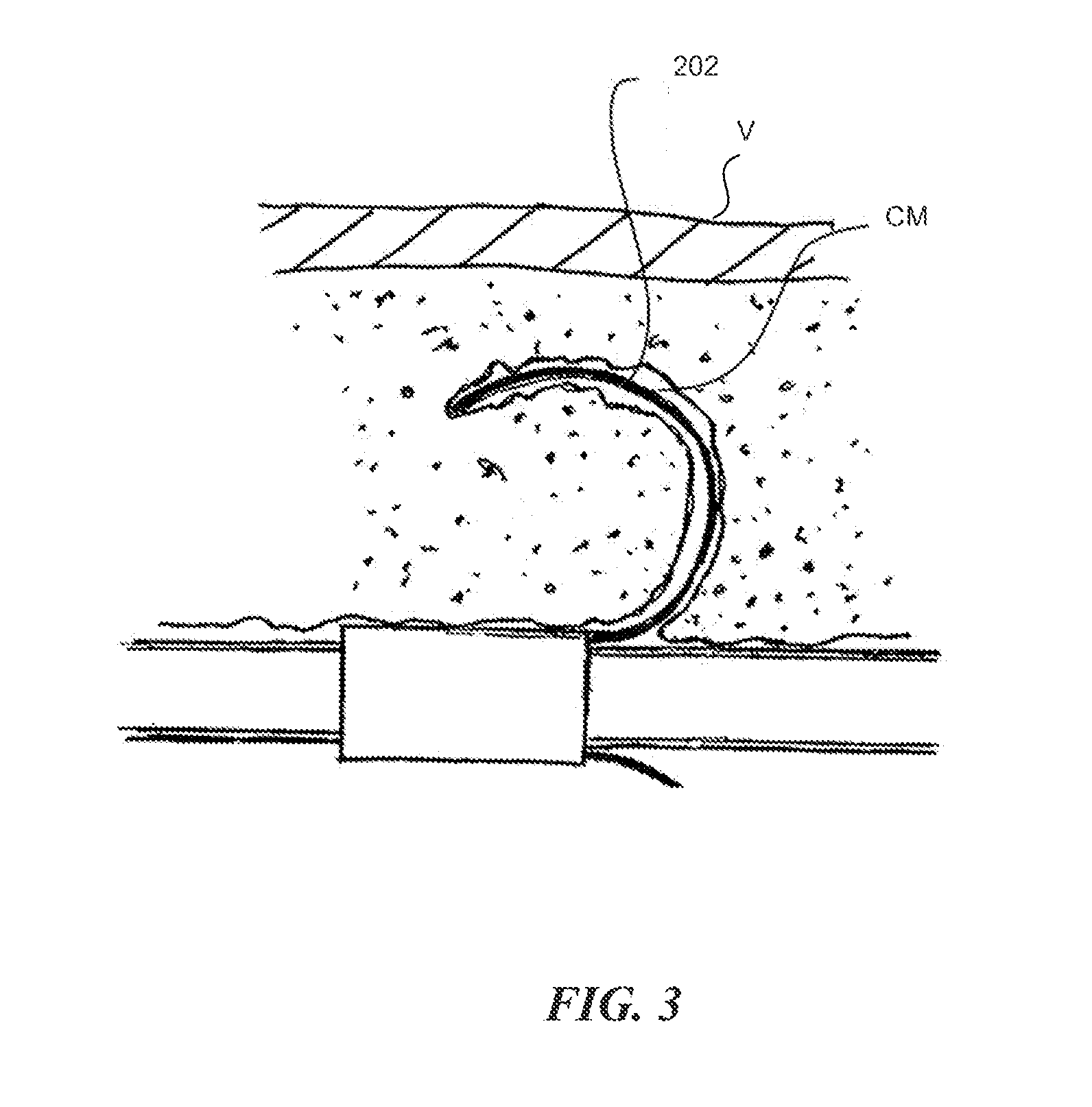 Methods and apparatus for treating embolism