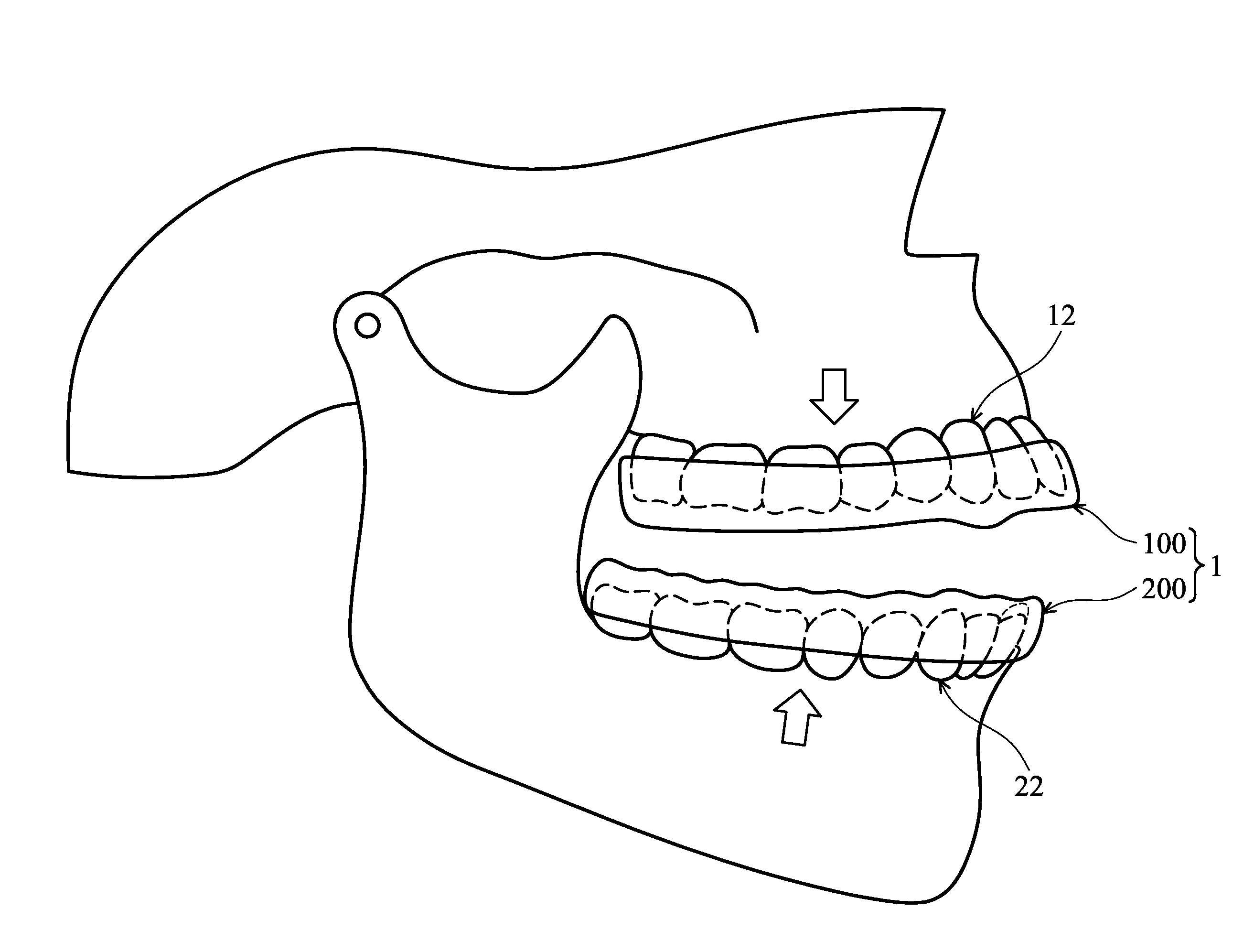 Masticatory orthodontic correction device
