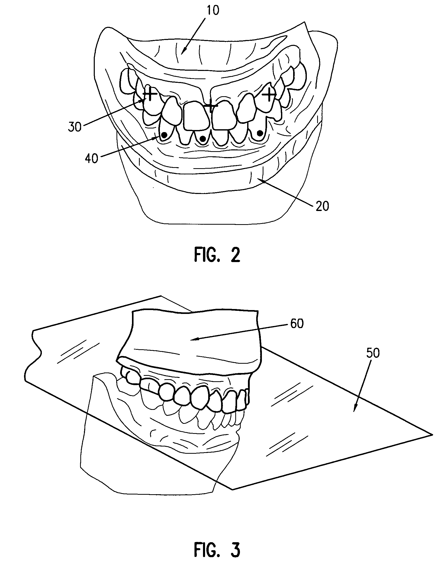 Digital manufacturing of removable oral appliances