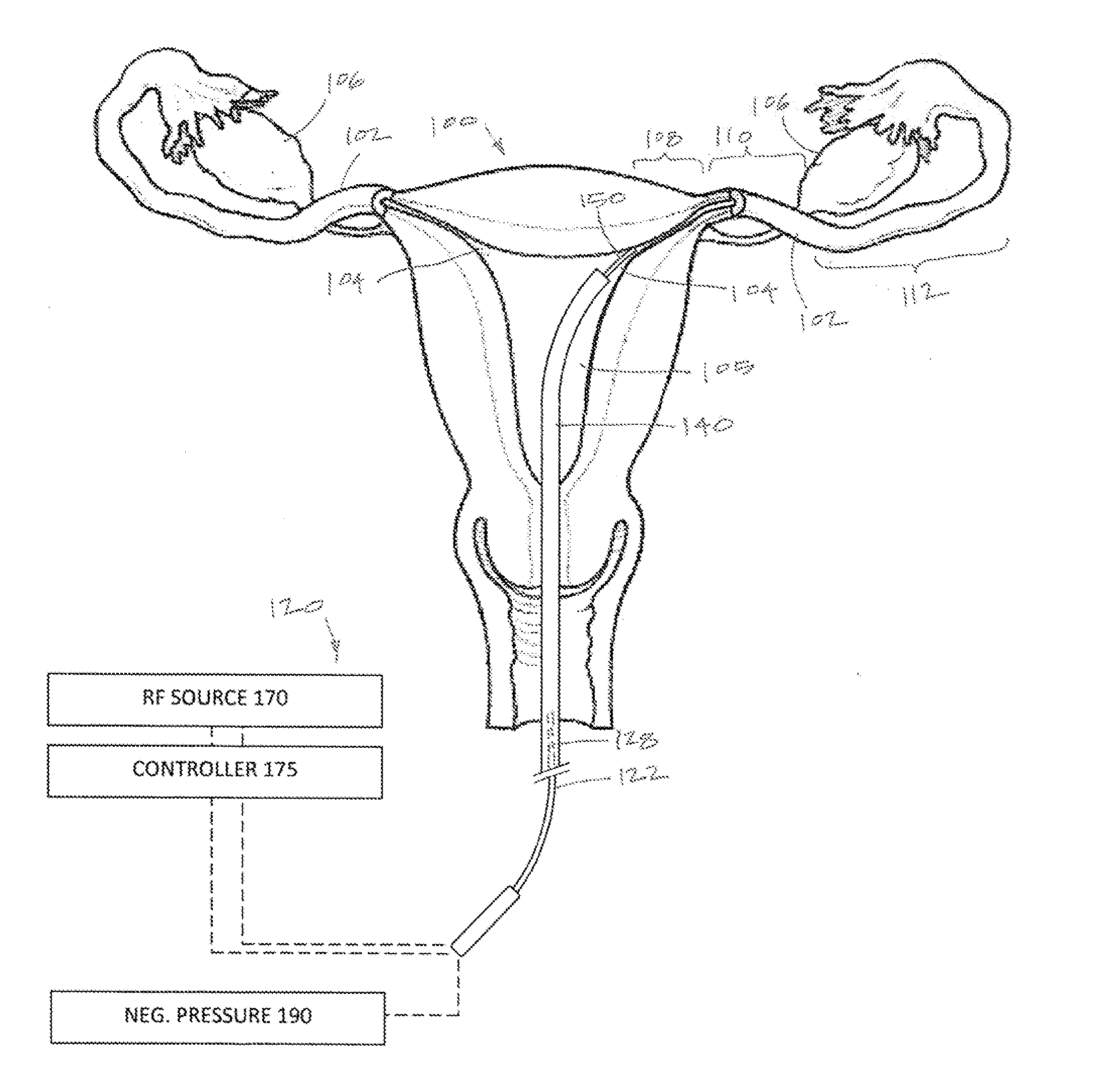 Systems and methods for permanent female contraception