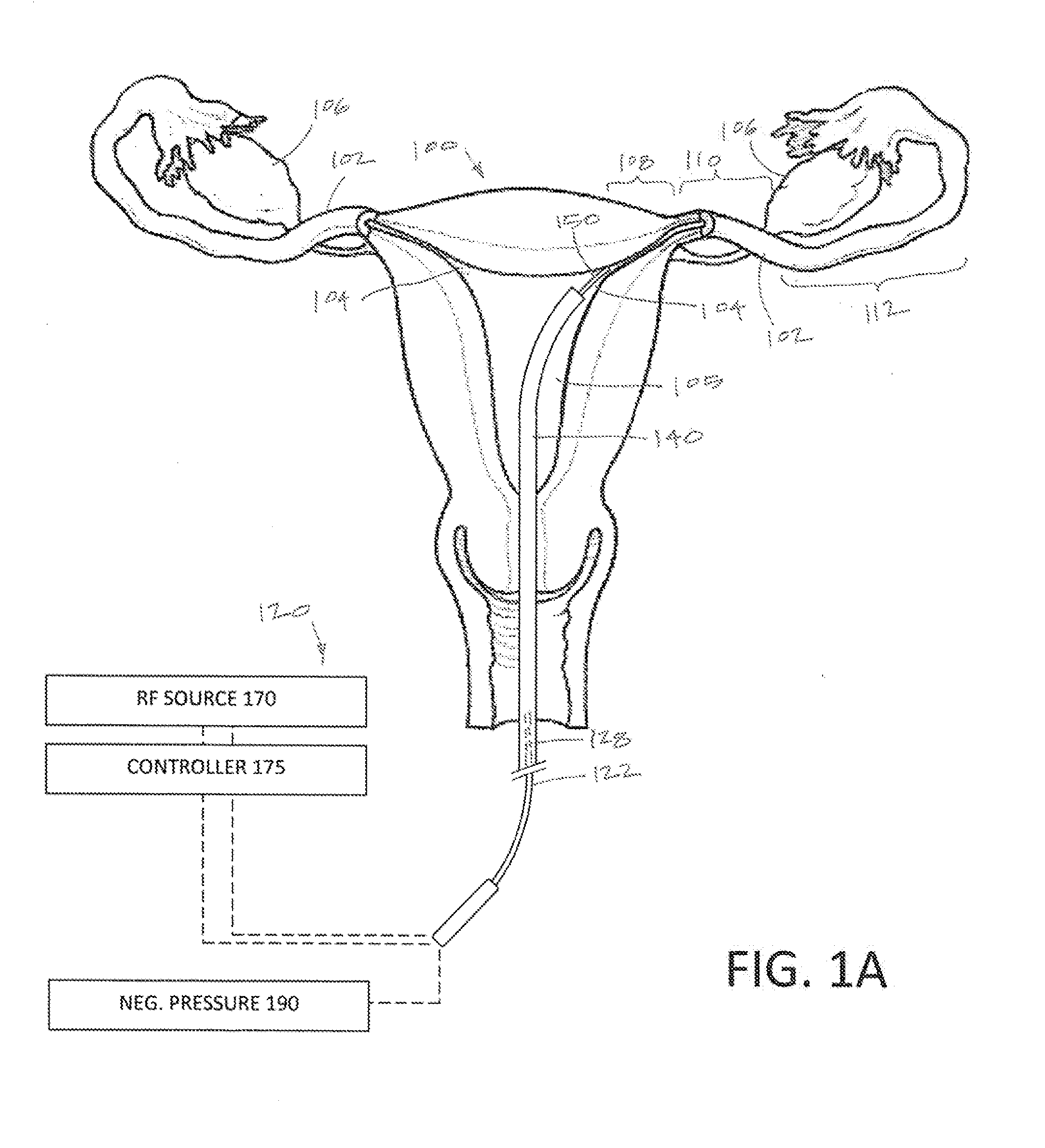 Systems and methods for permanent female contraception