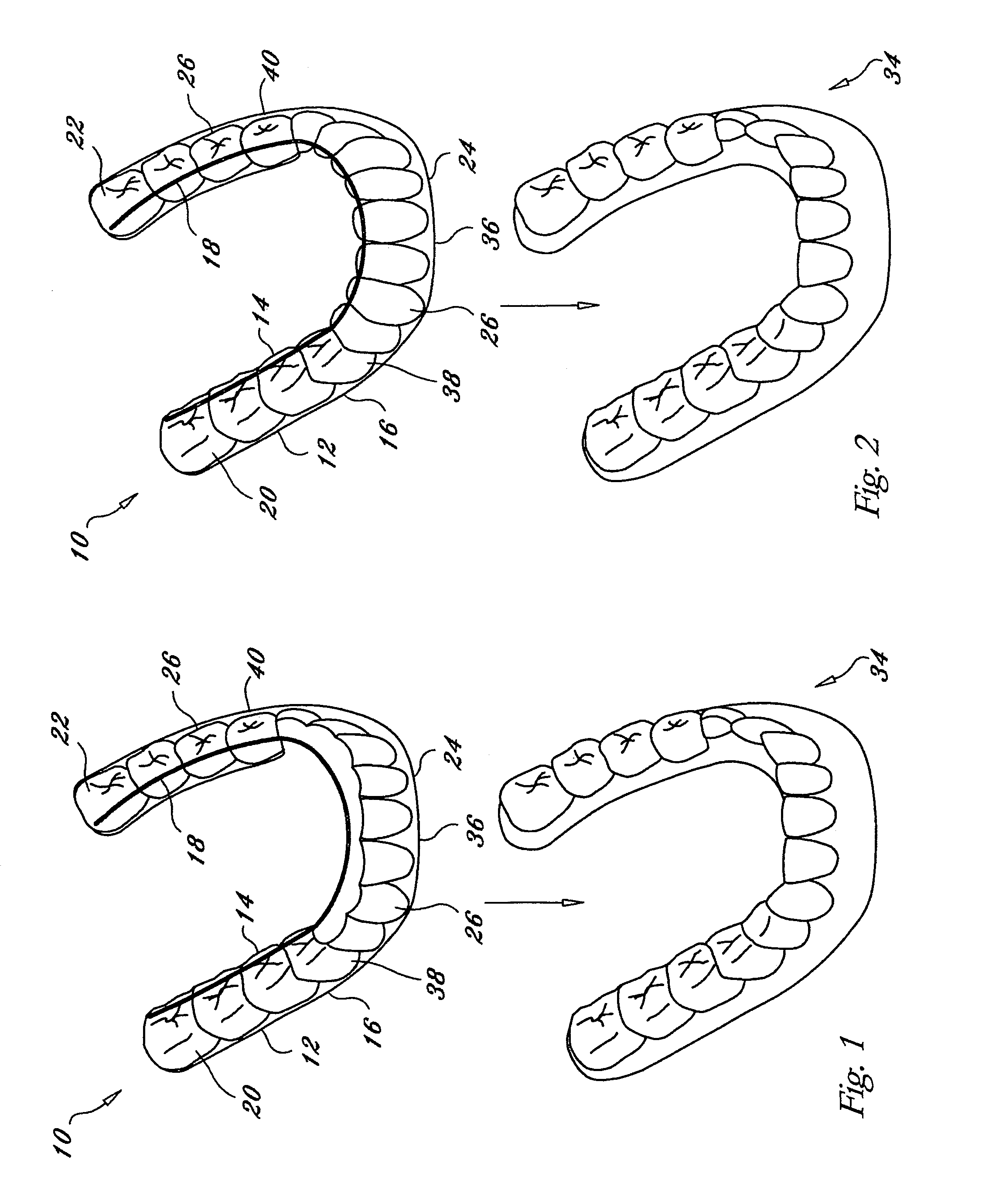 Orthodontic appliance with embedded wire for moving teeth and method