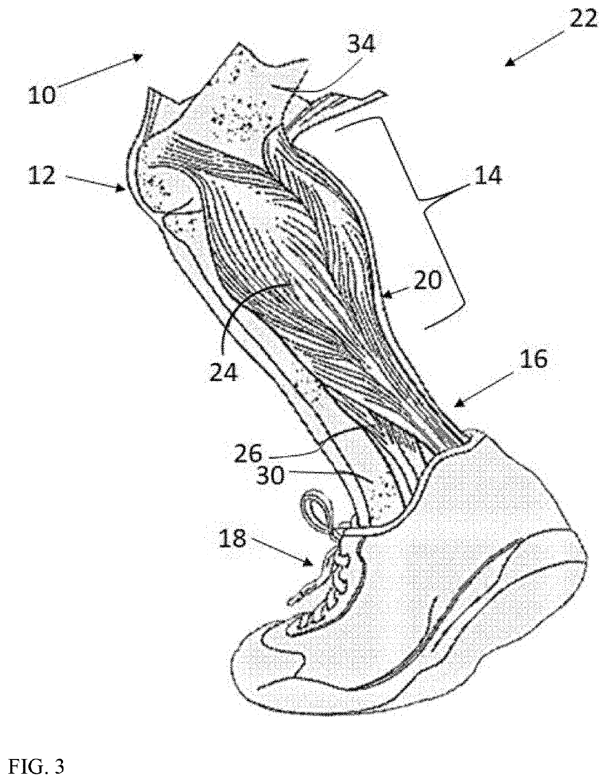 Dorsiflexion/plantarflexion extension above the knee brace