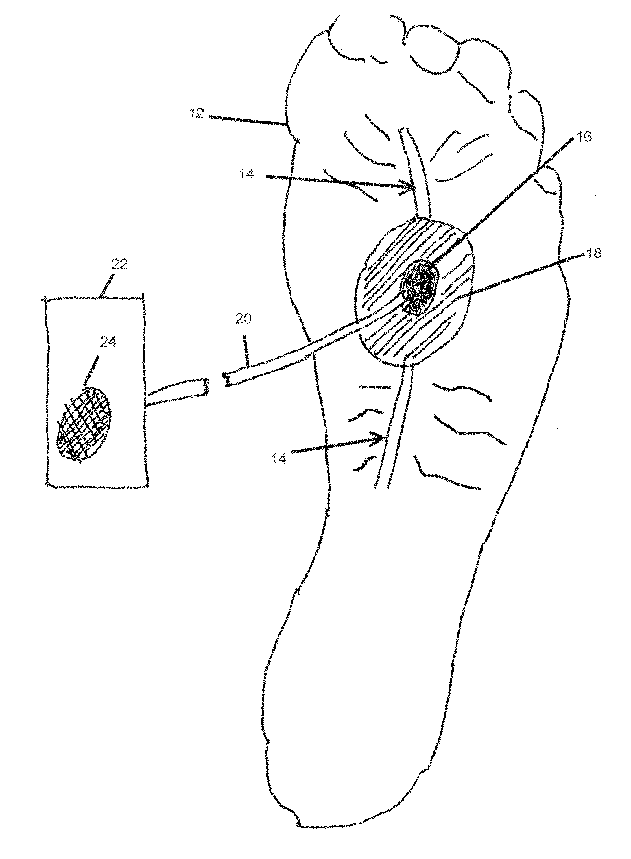 Non-invasive continuous doppler monitoring device for arterial blood flow to distal body parts