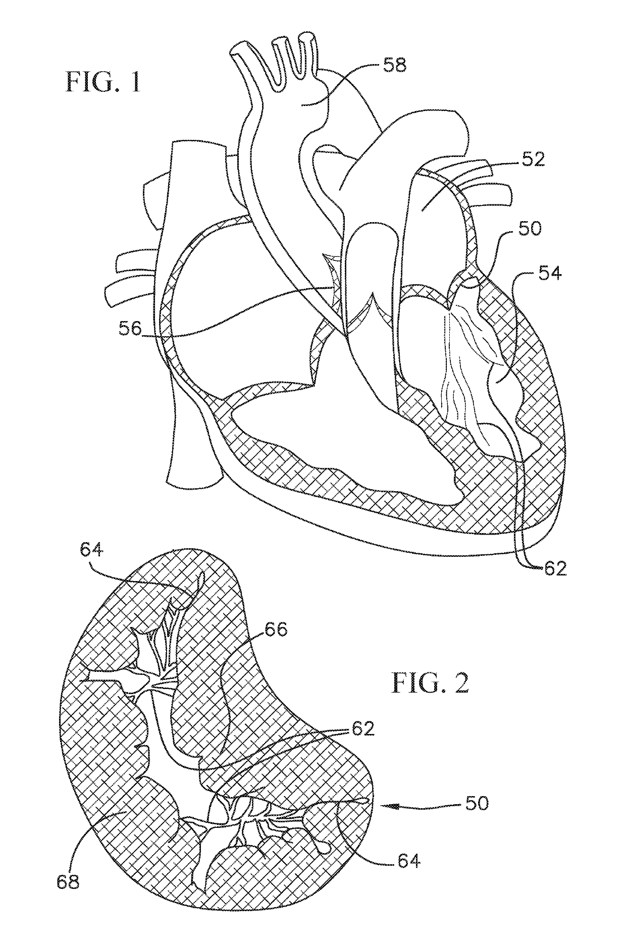 Heart valve docking coils and systems